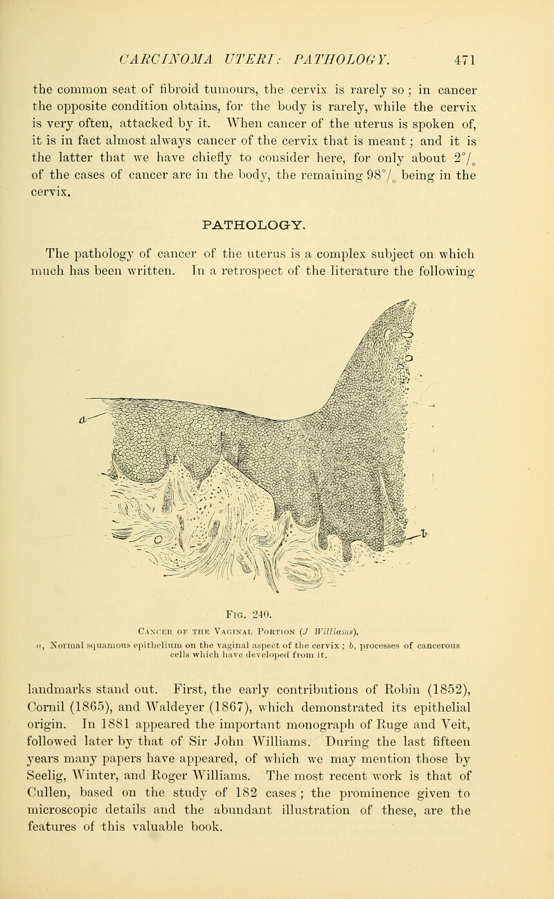 the common seat of fibroid tumours, the cervix is rarely so; in cancer the opposite condition obtains, for the body is rarely, while the cervix is very often, attacked by it. When cancer of the uterus is spoken of, it is in fact almost always cancer of the cervix that is meant; and it is the latter that we have chiefly to consider here, for only about 2°/o of the cases of cancer are in the body, the remaining 98°/o being in the cervix. PATHOLOGY. The pathology of cancer of the uterus is a complex subject on which much has been written. In a retrospect of the literature the following mmm Fig. 240. Cancer of the Vaginal Portion (J Williams). a, Normal squamous epithelium on the vaginal aspect of the cervix ; b, processes of cancerous cells which have developed from it. landmarks stand out. First, the early contributions of Robin (1852), Cornil (1865), and Waldeyer (1867), which demonstrated its epithelial origin. In 1881 appeared the important monograph of Paige and Veit, followed later by that of Sir John Williams. During the last fifteen years many papers have appeared, of which we may mention those by Seelig, Winter, and Roger Williams. The most recent wTork is that of Cullen, based on the study of 182 cases ; the prominence given to microscopic details and the abundant illustration of these, are the features of this valuable book.