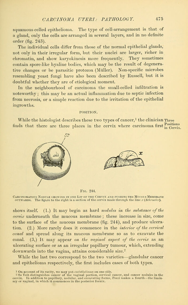 squamous-celled epithelioma. The type of cell-arrangement is that of a gland, only the cells are arranged in several layers, and in no definite order (fig. 243). The individual cells differ from those of the normal epithelial glands, not only in their irregular form, but their nuclei are larger, richer in chromatin, and show karyokinesis more frequently. They sometimes contain spore-like hyaline bodies, which may be the result of degenera- tive changes or be parasitic protozoa (Miiller). Non-specific microbes resembling yeast fungi have also been described by Russell, but it is doubtful whether they are of etiological moment. In the neighbourhood of carcinoma the small-celled infiltration is noteworthy; this may be an actual inflammation due to septic infection from necrosis, or a simple reaction due to the irritation of the epithelial ingrowths. POSITION. While the histologist describes these two types of cancer,1 the clinician Three Positio in Cervix. finds that there are three places in the cervix where carcinoma first c j Fig. 244. Carcinomatous Nodule growing in one Lip of the Cervix and pushing the Mucous Membrane outwards. The figure to the right is a section of the cervix made through the line x (Schroeder). shows itself. (1.) It may begin as hard nodules in the substance of the cervix underneath the mucous membrane; these increase in size, come to the surface of the mucous membrane (fig. 244), and produce ulcera- tion. (2.) More rarely does it commence in the interior of the cervical canal and spread along its mucous membrane so as to excavate the canal. (3.) It may appear on the vaginal aspect of the cervix as an ulcerating surface or as an irregular papillary tumour, which, extending downwards into the vagina, attains considerable size.2 While the last two correspond to the two varieties—glandular cancer and epithelioma respectively, the first includes cases of both types. 1 On account of its rarity, we may put endothelioma, on one side. 2 So Veit distinguishes cancer of the vaginal portion, cervical cancer, and cancer nodules in the cervix. In addition to papillary, nodular, and excavating forms, Poz.d makes a fourth—the limin- ary or vaginal, in which it commences in the posterior fornix.