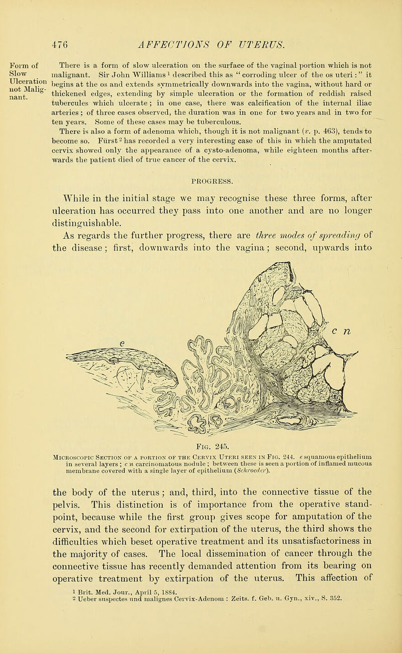 Form of Slow nant. There is a. form of slow ulceration on the surface of the vaginal portion which is not malignant. Sir John Williams1 described this as  corroding ulcer of the os uteri: it Ulceration lJegms at the os and extends symmetrically downwards into the vagina, without hard or  ' ■ thickened edges, extending by simple ulceration or the formation of reddish raised tubercules which ulcerate; in one case, there was calcification of the internal iliac arteries ; of three cases observed, the duration was in one for two years and in two for ten years. Some of these cases may be tuberculous. There is also a form of adenoma which, though it is not malignant (v. p. 463), tends to become so. Fiirst2has recorded a very interesting case of this in which the amputated cervix showed only the appearance of a cysto-adenoma, while eighteen months after- wards the patient died of true cancer of the cervix. PROGRESS. While in the initial stage we may recognise these three forms, after ulceration has occurred they pass into one another and are no longer distinguishable. As regards the further progress, there are three modes of spreading of the disease; first, downwards into the vagina; second, upwards into Fig. 245. Microscopic Section of a portion or the Cervix Uteri seen in Fig. 244. e squamous epithelium in several layers ; c n carcinomatous nodule ; between these is seen a portion of inflamed mucous membrane covered with a single layer of epithelium (Schroeder). the body of the uterus; and, third, into the connective tissue of the pelvis. This distinction is of importance from the operative stand- point, because while the first group gives scope for amputation of the cervix, and the second for extirpation of the uterus, the third shows the difficulties which beset operative treatment and its unsatisfactoriness in the majority of cases. The local dissemination of cancer through the connective tissue has recently demanded attention from its bearing on operative treatment by extirpation of the uterus. This affection of l Brit. Med. Jour., April 5, 1S84. - Ueber suspectes und malignes Cervix-Adenom : Zeits. f. Geb. u. Gyn., xiv., S. 352.