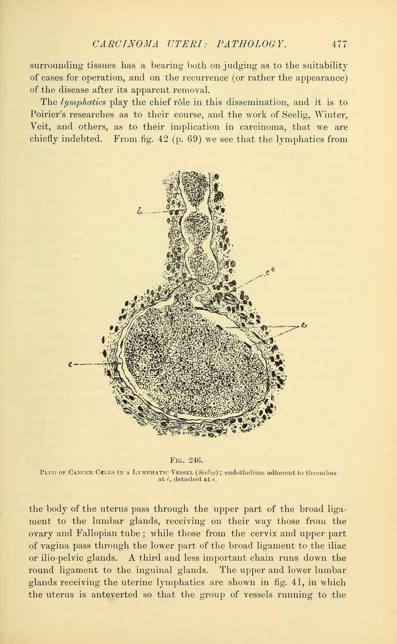 surrounding tissues has a bearing both on judging as to the suitability of cases for operation, and on the recurrence (or rather the appearance) of the disease after its apparent removal. The lymphatics play the chief role in this dissemination, and it is to Poirier's researches as to their course, and the work of Seelig, Winter, Veit, and others, as to their implication in carcinoma, that we are chiefly indebted. From fig. 42 (p. 69) we see that the lymphatics from € asTs WttttBBfi&& www Fig. 246. Plug of Cancer Cells in a Lymphatic Vessel (Seelig); endothelium adherent to thrombus at L detached at e. the body of the uterus pass through the upper part of the broad liga- ment to the lumbar glands, receiving on their way those from the ovary and Fallopian tube; while those from the cervix and upper part of vagina pass through the lower part of the broad ligament to the iliac or ilio-pelvic glands. A third and less important chain runs down the round ligament to the inguinal glands. The upper and lower lumbar glands receiving the uterine lymphatics are shown in fig. 41, in which the uterus is anteverted so that the group of vessels running to the