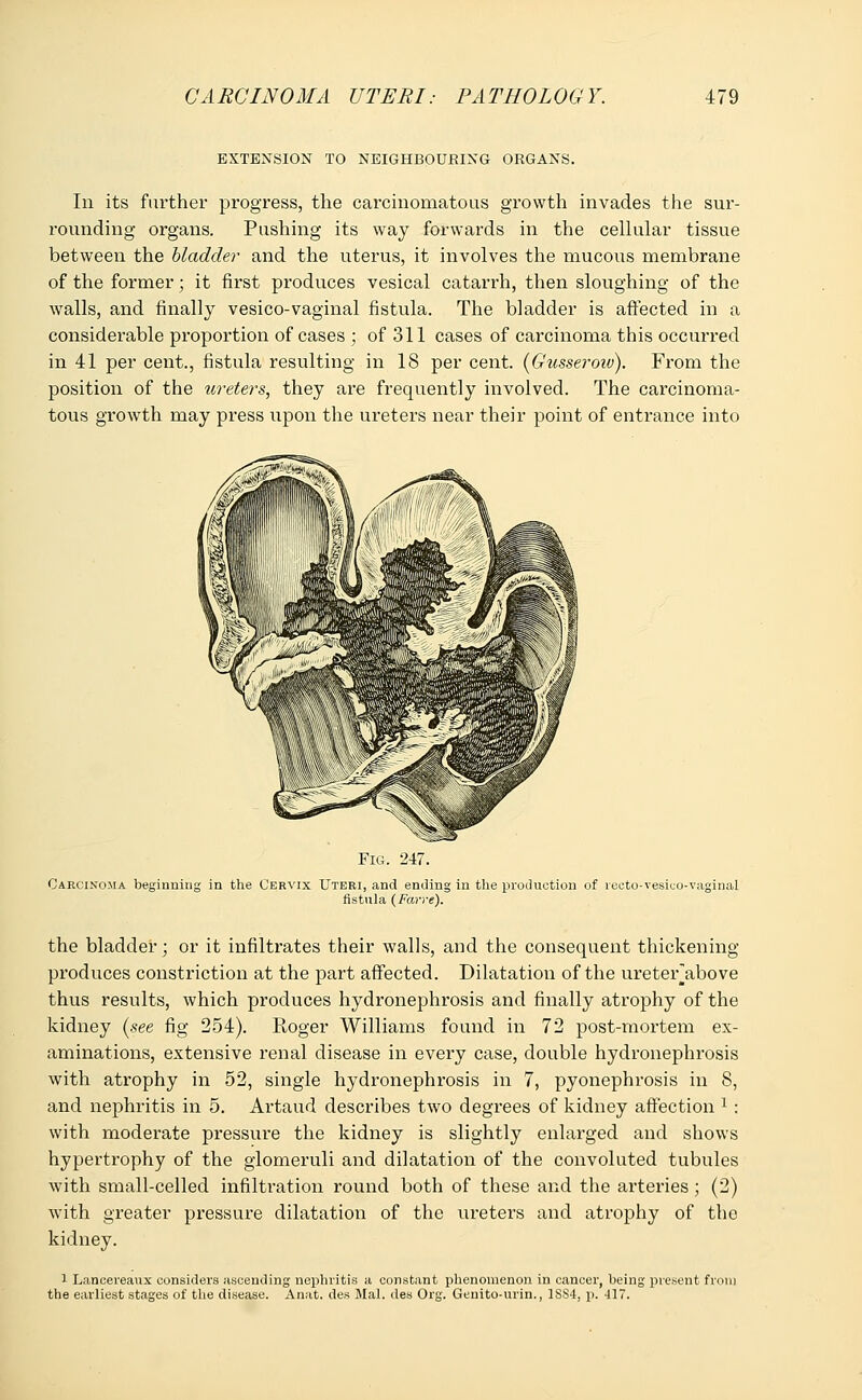 EXTENSION TO NEIGHBOURING ORGANS. In its further progress, the carcinomatous growth invades the sur- rounding organs. Pushing its way forwards in the cellular tissue between the bladder and the uterus, it involves the mucous membrane of the former; it fh'st produces vesical catarrh, then sloughing of the walls, and finally vesico-vaginal fistula. The bladder is affected in a considerable proportion of cases ; of 311 cases of carcinoma this occurred in 41 per cent., fistula resulting in 18 per cent. (Gusseroiv). From the position of the ureters, they are frequently involved. The carcinoma- tous growth may press upon the ureters near their point of entrance into Fig. 247. Carcinoma beginning in the Cervix Uteri, and ending in the production of recto-vesico-vaginal fistula (Farre). the bladder; or it infiltrates their walls, and the consequent thickening produces constriction at the part affected. Dilatation of the ureterabove thus results, which produces hydronephrosis and finally atrophy of the kidney (see fig 254). Roger Williams found in 72 post-mortem ex- aminations, extensive renal disease in every case, double hydronephrosis with atrophy in 52, single hydronephrosis in 7, pyonephrosis in 8, and nephritis in 5. Artaud describes two degrees of kidney affection 1 : with moderate pressure the kidney is slightly enlarged and shows hypertrophy of the glomeruli and dilatation of the convoluted tubules with small-celled infiltration round both of these and the arteries; (2) with greater pressure dilatation of the ureters and atrophy of the kidney. 1 Lancereaux considers ascending nephritis a constant phenomenon in cancer, being present from the earliest stages of the disease. Anat. des Mai. des Org. Genito-urin., 1SS4, p. 417.