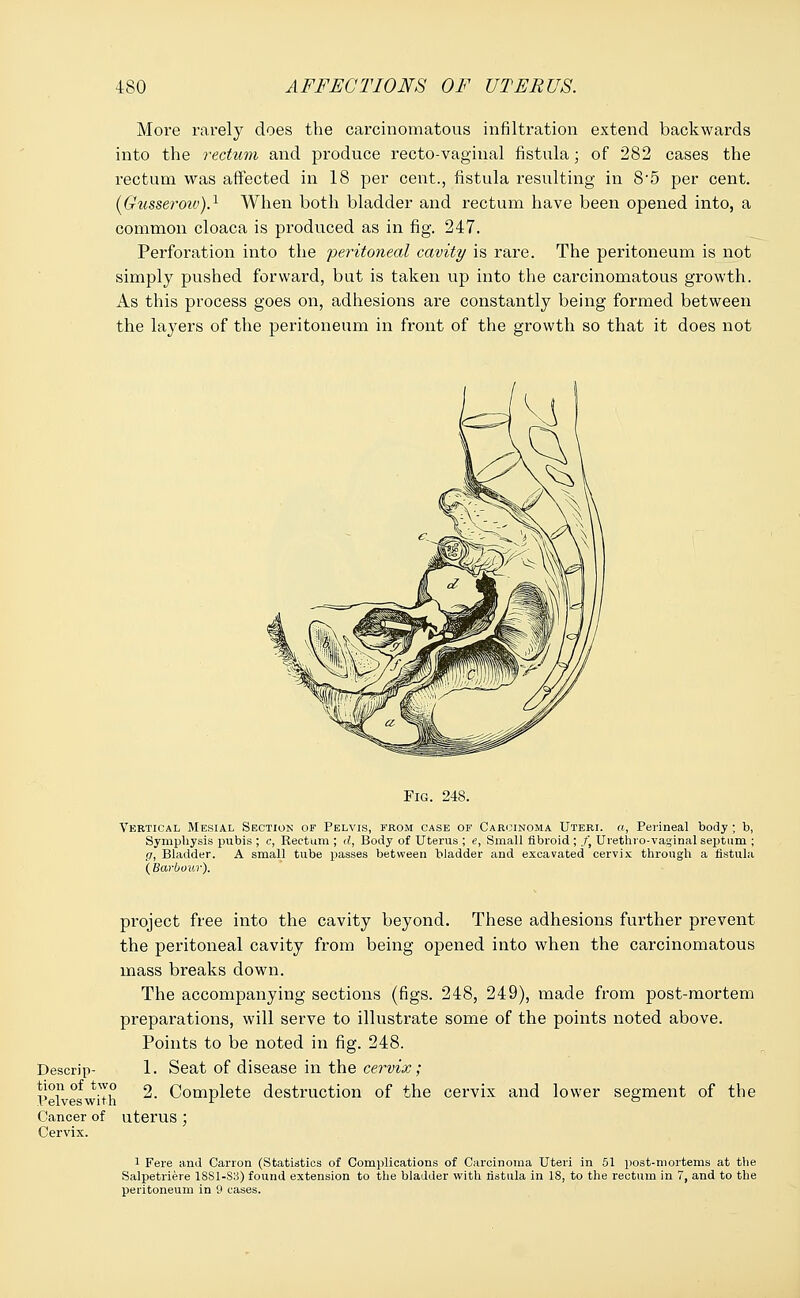 More rarely does the carcinomatous infiltration extend backwards into the rectum and produce recto-vaginal fistula; of 282 cases the rectum was affected in 18 per cent., fistula resulting in 85 per cent. (Gtisseroiv).1 When both bladder and rectum have been opened into, a common cloaca is produced as in fig. 247. Perforation into the peritoneal cavity is rare. The peritoneum is not simply pushed forward, but is taken up into the carcinomatous growth. As this process goes on, adhesions are constantly being formed between the layers of the peritoneum in front of the growth so that it does not Fig. 248. Vertical Mesial Section of Pelvis, from case of Carcinoma Uteri, a, Perineal body ; b, Symphysis pubis ; c, Rectum ; d, Body of Uterus ; e, Small fibroid ; /, Urethro-vaginal septum ; g, Bladder. A small tube passes between bladder and excavated cervix through a fistula ( Barbour). Descrip- tion of two Velveswith Cancer of Cervix. project free into the cavity beyond. These adhesions further prevent the peritoneal cavity from being opened into when the carcinomatous mass breaks down. The accompanying sections (figs. 248, 249), made from post-mortem preparations, will serve to illustrate some of the points noted above. Points to be noted in fig. 248. 1. Seat of disease in the cervix; 2. Complete destruction of the cervix and lower segment of the uterus; l Fere and Carron (Statistics of Complications of Carcinoma Uteri in 51 post-mortems at the Salpetriere 1SS1-S3) found extension to the bladder with fistula in 18, to the rectum in 7, and to the peritoneum in 9 cases.