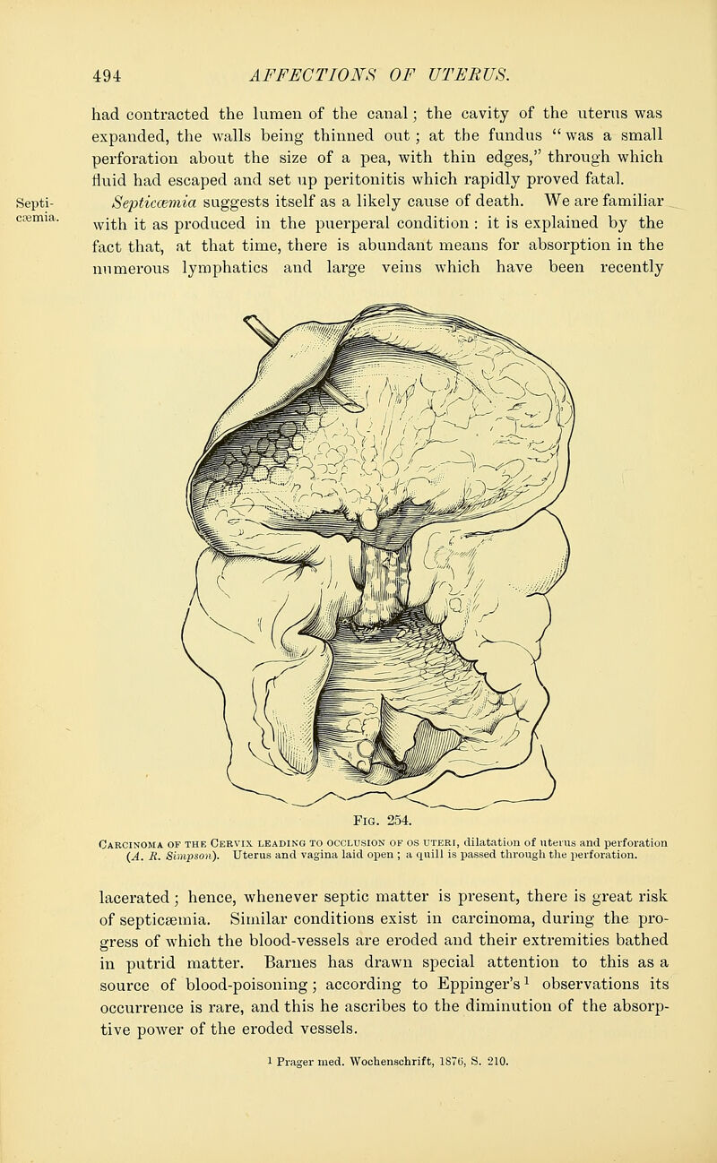 Septi- cemia. had contracted the lumen of the canal; the cavity of the uterus was expanded, the walls being thinned out; at the fundus  was a small perforation about the size of a pea, with thin edges, through which lluid had escaped and set up peritonitis which rapidly proved fatal. Septiccemia suggests itself as a likely cause of death. We are familiar with it as produced in the puerperal condition : it is explained by the fact that, at that time, there is abundant means for absorption in the numerous lymphatics and large veins which have been recently Fig. 254. Carcinoma of the Cervix leading to occlusion of os uteri, dilatation of uterus and perforation {A. R. Simpson). Uterus and vagina laid open ; a quill is passed through the perforation. lacerated; hence, whenever septic matter is present, there is great risk of septicaemia. Similar conditions exist in carcinoma, during the pro- gress of which the blood-vessels are eroded and their extremities bathed in putrid matter. Barnes has drawn special attention to this as a source of blood-poisoning; according to Eppinger's1 observations its occurrence is rare, and this he ascribes to the diminution of the absorp- tive power of the eroded vessels. 1 Prager med. Wochenschrift, 1S76, S. 210.