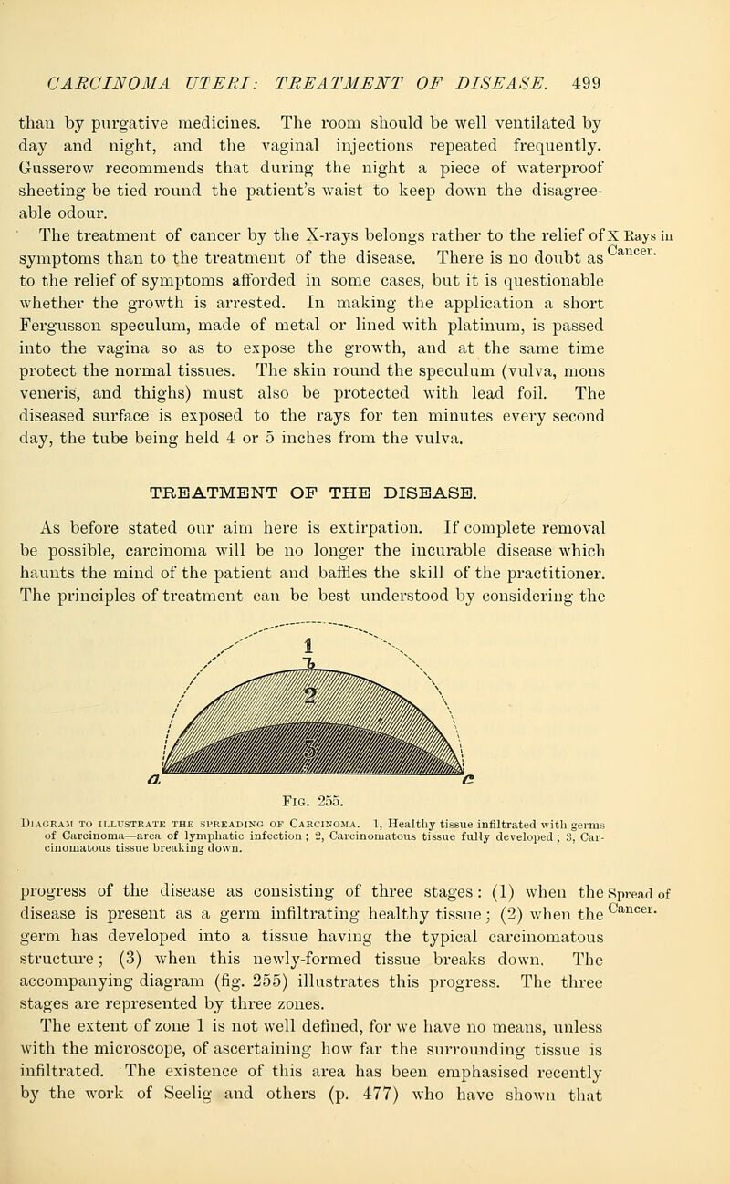 Cancer. than by purgative medicines. The room should be well ventilated by day and night, and the vaginal injections repeated frequently. Gusserow recommends that during the night a piece of watei^pi'oof sheeting be tied round the patient's waist to keep down the disagree- able odour. The treatment of cancer by the X-rays belongs rather to the relief of X Rays in symptoms than to the treatment of the disease. There is no doubt as to the relief of symptoms afforded in some cases, but it is questionable whether the growth is arrested. In making the application a short Fergusson speculum, made of metal or lined with platinum, is passed into the vagina so as to expose the growth, and at the same time protect the normal tissues. The skin round the speculum (vulva, mons veneris, and thighs) must also be protected with lead foil. The diseased surface is exposed to the rays for ten minutes every second day, the tube being held 4 or 5 inches from the vulva. TREATMENT OF THE DISEASE. As before stated our aim here is extirpation. If complete removal be possible, carcinoma will be no longer the incurable disease which haunts the mind of the patient and baffles the skill of the practitioner. The principles of treatment can be best understood by considering the Fig. 255. Diagram to illustrate the spreading of Carcinoma. 1, Healthy tissue infiltrated with germs of Carcinoma—area of lymphatic infection ; 2, Carcinomatous tissue fully developed ; 3, Car- cinomatous tissue breaking down. progress of the disease as consisting of three stages: (1) when the Spread of disease is present as a germ infiltrating healthy tissue; (2) when the Cancer- germ has developed into a tissue having the typical carcinomatous structure; (3) when this newly-formed tissue breaks down. The accompanying diagram (fig. 255) illustrates this progress. The three stages are represented by three zones. The extent of zone 1 is not well defined, for we have no means, unless with the microscope, of ascertaining how far the surrounding tissue is infiltrated. The existence of this area has been emphasised recently by the work of Seelig and others (p. 477) who have shown that