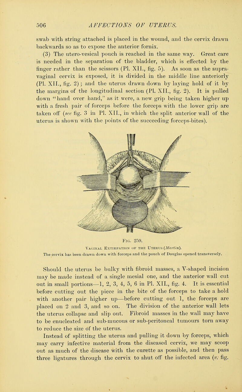 swab with string attached is placed in the wound, and the cervix drawn backwards so as to expose the anterior fornix. (3) The utero-vesical pouch is reached in the same way. Great care is needed in the separation of the bladder, which is effected by the finger rather than the scissors (PL XII., fig. 5). As soon as the supra- vaginal cervix is exposed, it is divided in the middle line anteriorly (PI. XII., fig. 2); and the uterus drawn down by laying hold of it by the margins of the longitudinal section (PL XII., fig. 2). It is pulled down hand over hand, as it were, a new grip being taken higher up with a fresh pair of forceps before the forceps with the lower grip are taken off (see fig. 3 in PL XII., in which the split anterior wall of the uterus is shown with the points of the succeeding forceps-bites). Fig. 259. Vaginal Extirpation of the Uterus (Martin). The cervix has been drawn down with forceps and the pouch of Douglas opened transversely. Should the uterus be bulky with fibroid masses, a Y-shaped incision may be made instead of a single mesial one, and the anterior wall cut out in small portions—1, 2, 3, 4, 5, 6 in PL XII., fig. 4. It is essential before cutting out the piece in the bite of the forceps to take a hold with another pair higher up—before cutting out 1, the forceps are placed on 2 and 3, and so on. The division of the anterior wall lets the uterus collapse and slip out. Fibroid masses in the wall may have to be enucleated and sub-mucous or sub-peritoneal tumours torn away to reduce the size Of the uterus. Instead of splitting the uterus and pulling it down by forceps, which may carry infective material from the diseased cervix, we may scoop out as much of the disease with the curette as possible, and then pass three ligatures through the cervix to shut off the infected area (v: fig.