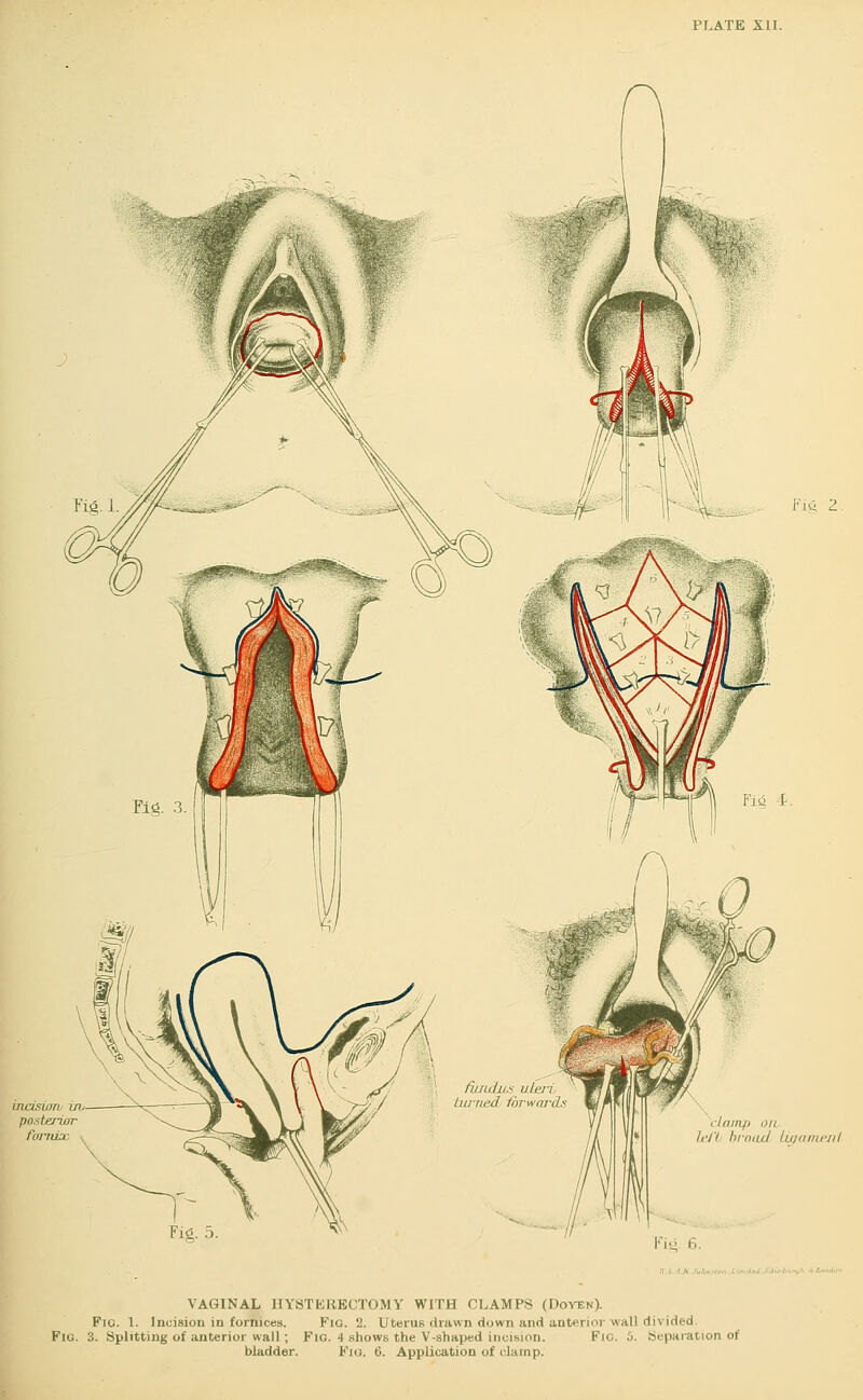 PLATE XII. Fig 2 Fid i. lujamciil Fig. 5 ■ VAGINAL HYSTERECTOMY WITH CLAMPS (Doyen). Fig. 1. Incision in fornices. Fig. 2. Uterus drawn down and anterior wall divided Fig. 3. Splitting of anterior wall; Fig. 4 shows the V-shaped incision. Fig. 5. Separation of bladder. Fig. 6. Application of clamp.