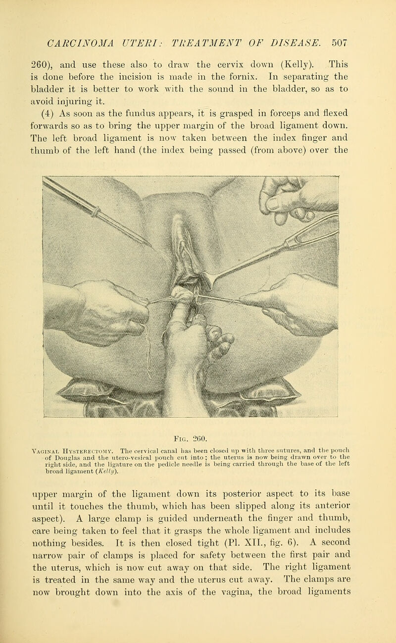 260), and use these also to draw the cervix down (Kelly). This is done before the incision is made in the fornix. In separating the bladder it is better to work with the sound in the bladder, so as to avoid injuring it. (4) As soon as the fundus appears, it is grasped in forceps and flexed forwards so as to bring the upper margin of the broad ligament down. The left broad ligament is now taken between the index finger and thumb of the left hand (the index being passed (from above) over the Fig. 260. Vaginal Hysterectomy. The cervical canal has been closed up with three sutures, and the pouch of Douglas and the utero-vesical pouch cut into; the uterus is now being drawn over to the right side, and the ligature on the pedicle needle is being carried through the base of the left broad ligament (Kelly). upper margin of the ligament down its posterior aspect to its base until it touches the thumb, which has been slipped along its anterior aspect). A large clamp is guided underneath the finger and thumb, care being taken to feel that it grasps the whole ligament and includes nothing besides. It is then closed tight (PI. XII., fig. 6). A second narrow pair of clamps is placed for safety between the first pair and the uterus, which is now cut away on that side. The right ligament is treated in the same way and the uterus cut away. The clamps are now brought down into the axis of the vagina, the broad ligaments