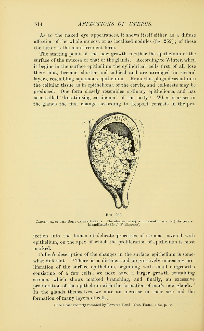 As to the naked eye appearances, it shows itself either as a diffuse affection of the whole mucosa or as localised nodules (fig. 262); of these the latter is the more frequent form. The starting point of the new growth is either the epithelium of the surface of the mucosa or that of the glands. According to Winter, when it begins in the surface epithelium the cylindrical cells first of all lose their cilia, become shorter and cubical and are arranged in several layers, resembling squamous epithelium. From this plugs descend into the cellular tissue as in epithelioma of the cervix, and cell-nests may be produced. One form closely resembles ordinary epithelioma, and has been called keratinising carcinoma of the body 1 When it arises in the glands the first change, according to Leopold, consists in the pro- Fig. 263. Carcinoma of the Body of the Uterus. The uterine cavity is increased in size, but the cervix is undilated (Sir J. Y. Simpson). jection into the lumen of delicate processes of stroma, covered with epithelium, on the apex of which the proliferation of epithelium is most marked. Cullen's description of the changes in the surface epithelium is some- what different.  There is a distinct and progressively increasing pro- liferation of the surface epithelium, beginning with small outgrowths consisting of a few cells ; we next have a larger growth containing stroma, which shows marked brandling, and finally, an excessive proliferation of the epithelium with the formation of maify new glands. In the glands themselves, we note an increase in their size and the formation of many layers of cells. 1 See a case recently recorded by Lewers : Lond. Obst. Trans., 1003, p. 79.