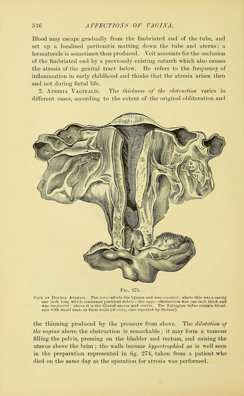 Blood may escape gradually from the fimbriated end of the tube, and set up a localised peritonitis matting down the tube and uterus; a hsematocele is sometimes thus produced. Veit accounts for the occlusion of the fimbriated end by a previously existing catarrh which also causes the atresia of the genital tract below. He refers to the frequency of inflammation in early childhood and thinks that the atresia arises then and not during foetal life. 2. Atresia Vaginalis. The thickness of the obstruction varies in different cases, according to the extent of the original obliteration and it ■lis Hi Fig. 275. Case of Double Atresia. The lower affects the hymen and was acquired; above this was a cavity one inch long which contained purulent debris : the upper obstruction was one inch thick and was congenital; above it is the dilated uterus and cervix. The Fallopian tubes contain blood- sacs with small rents in their walls (Breisky, case reported by Steiner). the thinning produced by the pressure from above. The dilatation of the vagina above the obstruction is remarkable; it may form a tumour filling the pelvis, pressing on the bladder and rectum, and raising the uterus above the brim ; the walls become hypertrophied as is well seen in the preparation represented in fig. 274, taken from a patient who died on the same day as the operation for atresia was performed.