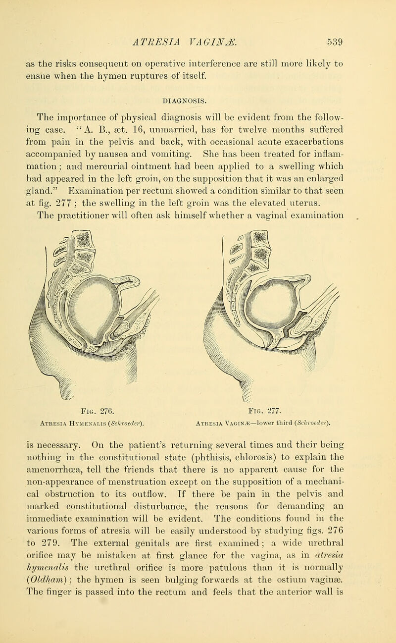 as the risks consequent on operative interference are still more likely to ensue when the hymen ruptures of itself. DIAGNOSIS. The importance of physical diagnosis will be evident from the follow- ing case. A. B., a?t. 16, unmarried, has for twelve months suffered from pain in the pelvis and back, with occasional acute exacerbations accompanied by nausea and vomiting. She has been treated for inflam- mation ; and mercurial ointment had been applied to a swelling which had appeared in the left groin, on the supposition that it was an enlarged gland. Examination per rectum showed a condition similar to that seen at fig. 277; the swelling in the left groin was the elevated uterus. The practitioner will often ask himself whether a vaginal examination Fig. 276. Atresia Hymenalis (Schroeder). Fig. 277. Atresia Vagina—lower third (Schroeder). is necessary. On the patient's returning several times and their being nothing in the constitutional state (phthisis, chlorosis) to explain the amenorrhcea, tell the friends that there is no apparent cause for the non-appearance of menstruation except on the supposition of a mechani- cal obstruction to its outflow. If there be pain in the pelvis and marked constitutional disturbance, the reasons for demanding an immediate examination will be evident. The conditions found in the various forms of atresia will be easily understood by studying figs. 276 to 279. The external genitals are first examined; a wide urethral orifice may be mistaken at first glance for the vagina, as in atresia hymenalis the urethral orifice is more patulous than it is normally (Oldham); the hymen is seen bulging forwards at the ostium vagina?. The finger is passed into the rectum and feels that the anterior wall is