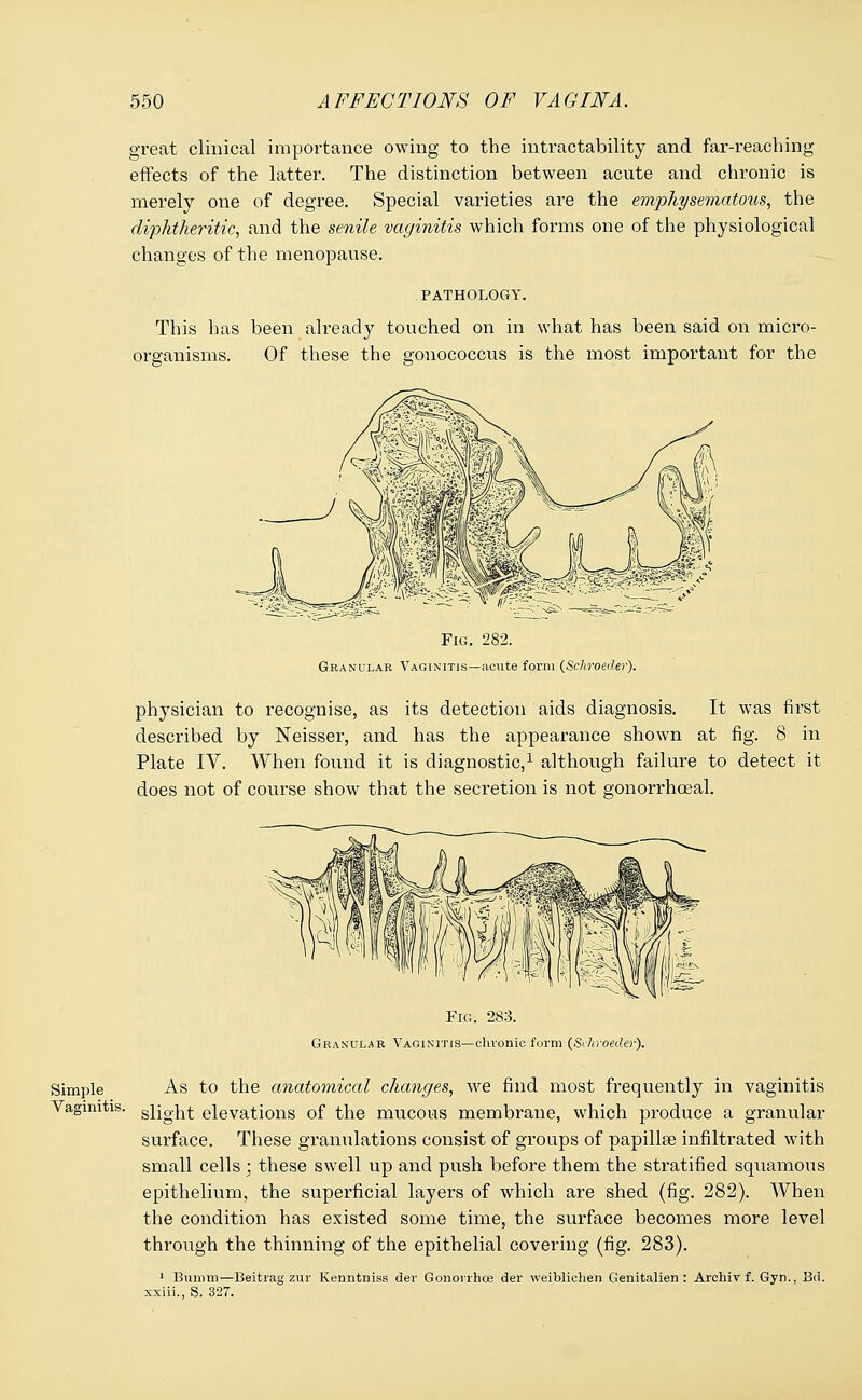 great clinical importance owing to the intractability and far-reaching effects of the latter. The distinction between acute and chronic is merely one of degree. Special varieties are the emphysematous, the diphtheritic, and the senile vaginitis which forms one of the physiological changes of the menopause. PATHOLOGY. This has been already touched on in what has been said on micro- organisms. Of these the gonococcus is the most important for the Fig. 282. Granular Vaginitis—acvite form (Schroeder). physician to recognise, as its detection aids diagnosis. It was first described by Neisser, and has the appearance shown at fig. 8 in Plate IV. When found it is diagnostic,1 although failure to detect it does not of course show that the secretion is not gonorrhceal. Simple Vaginitis. Fig. 283. Granular Vaginitis—clu-onic form (Schroeder). As to the anatomical changes, we find most frequently in vaginitis slight elevations of the mucous membrane, which produce a granular surface. These granulations consist of groups of papillae infiltrated with small cells ; these swell up and push before them the stratified squamous epithelium, the superficial layers of which are shed (fig. 282). When the condition has existed some time, the surface becomes more level through the thinning of the epithelial covering (fig. 283). 1 Bumni—Beitrag zur Kenntniss der Gonorrhce der weibliclien Genitalien : Archiv f. Gyn., Bd. xxiii., S. 327.