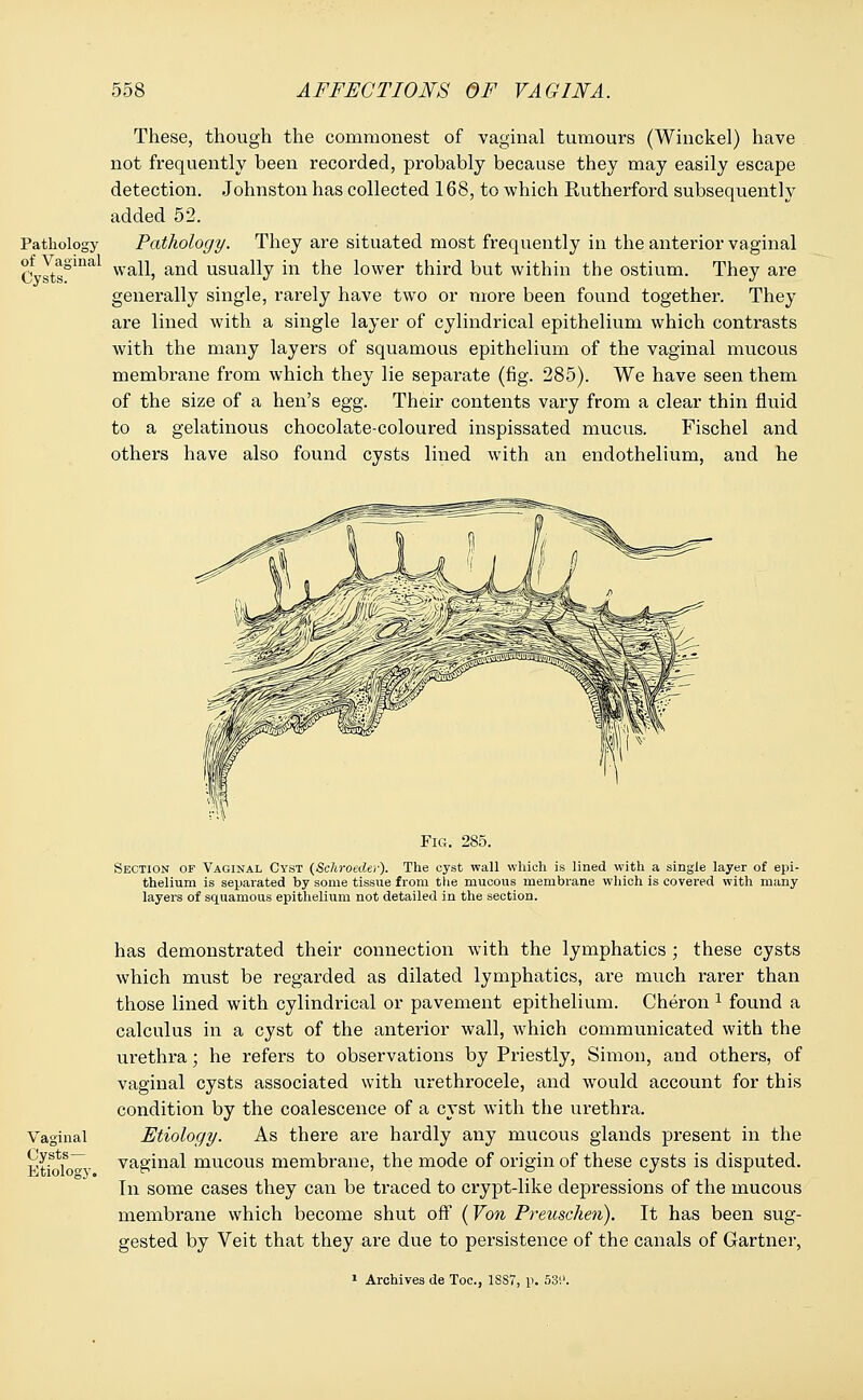 Pathology of Vaginal Cysts. These, though the commonest of vaginal tumours (Winckel) have not frequently been recorded, probably because they may easily escape detection. Johnston has collected 168, to which Rutherford subsequently added 52. Pathology. They are situated most frequently in the anterior vaginal wall, and usually in the lower third but within the ostium. They are generally single, rarely have two or more been found together. They are lined with a single layer of cylindrical epithelium which contrasts with the many layers of squamous epithelium of the vaginal mucous membrane from which they lie separate (fig. 285). We have seen them of the size of a hen's egg. Their contents vary from a clear thin fluid to a gelatinous chocolate-coloured inspissated mucus. Fischel and others have also found cysts lined with an endothelium, and he Fig. 285. Section of Vaginal Cyst (Schroeder). The cyst wall which is lined with a single layer of epi- thelium is separated by some tissue from the mucous membrane which is covered with many layers of squamous epithelium not detailed in the section. Vaginal Cysts— Etiology. has demonstrated their connection wTith the lymphatics ; these cysts which must be regarded as dilated lymphatics, are much rarer than those lined with cylindrical or pavement epithelium. Cheron 1 found a calculus in a cyst of the anterior wall, which communicated with the urethra; he refers to observations by Priestly, Simon, and others, of vaginal cysts associated with urethrocele, and would account for this condition by the coalescence of a cyst with the urethra. Etiology. As there are hardly any mucous glands present in the vaginal mucous membrane, the mode of origin of these cysts is disputed. In some cases they can be traced to crypt-like depressions of the mucous membrane which become shut off (Von Preuschen). It has been sug- gested by Veit that they are due to persistence of the canals of Gartner, 1 Archives de Toe, 1SS7, p. 53!'.