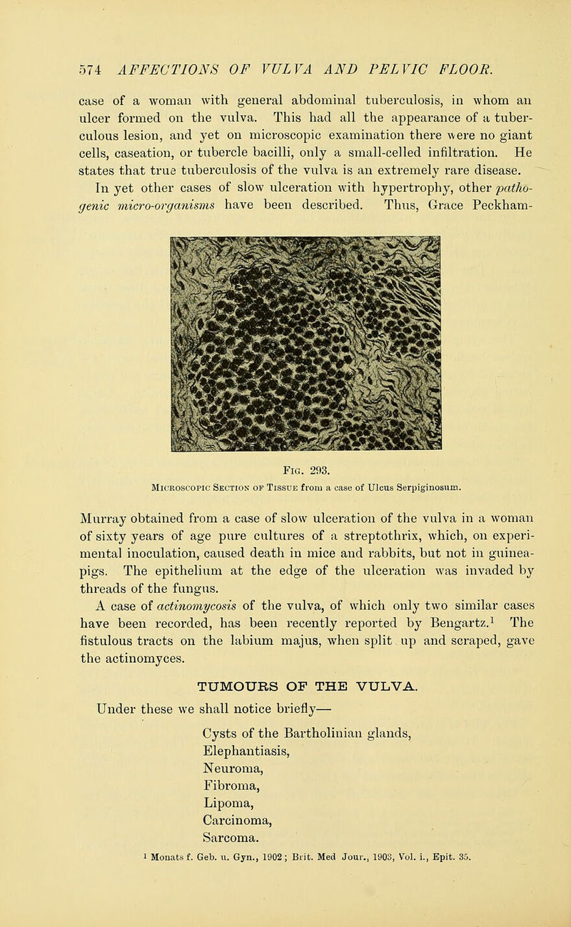 case of a woman with general abdominal tuberculosis, in whom an ulcer formed on the vulva. This had all the appearance of a tuber- culous lesion, and yet on microscopic examination there were no giant cells, caseation, or tubercle bacilli, only a small-celled infiltration. He states that true tuberculosis of the vulva is an extremely rare disease. In yet other cases of slow ulceration with hypertrophy, other patho- genic micro-organisms have been described. Thus, Grace Peckham- Fig. 293. Microscopic Section op Tissue from a case of Ulcus Serpiginosum. Murray obtained from a case of slow ulceration of the vulva in a woman of sixty years of age pure cultures of a streptothrix, which, on experi- mental inoculation, caused death in mice and rabbits, but not in guinea- pigs. The epithelium at the edge of the ulceration was invaded by threads of the fungus. A case of actinomycosis of the vulva, of which only two similar cases have been recorded, has been recently reported by Bengartz.1 The fistulous tracts on the labium majus, when split. up and scraped, gave the actinomyces. TUMOURS OF THE VULVA. Under these we shall notice briefly— Cysts of the Bartholinian glands, Elephantiasis, Neuroma, Fibroma, Lipoma, Carcinoma, Sarcoma. i Monatsf. Geb. u. Gyn., 1902; Brit. Med Jour., 1903, Vol. i., Epit. 35.