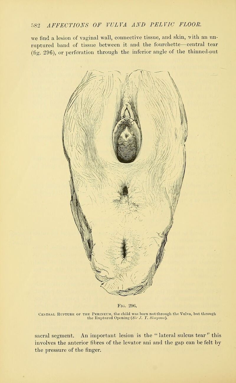 we find a lesion of vaginal wall, connective tissue, and skin, with an un- ruptured band of tissue between it and the fourchette—central tear (fig. 296), or perforation through the inferior angle of the thinned-out Fig. 296. Central Rupture of the Perineum, the child was bom not through the Vulva, but through the Ruptured Opening (Sir J. Y. Simpson). sacral segment. An important lesion is the lateral sulcus tear this involves the anterior fibres of the levator ani and the gap can be felt by the pressure of the finger.