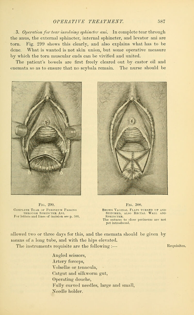 3. Operation for tear involving sphincter ani. In complete tear through the anus, the external sphincter, internal sphincter, and levator ani are torn. Fig. 299 shows this clearly, and also explains what has to be done. What is wanted is not skin union, but some operative measure by which the torn muscular ends can be vivified and united. The patient's bowels are first freely cleared out by castor oil and enemata so as to ensure that no scybala remain. The nurse should be Fig. 299. Complete Tear of Perineum Passing through Sphincter Ani. For letters and lines of incision see p. 5SS. Fig. 300. Shows Vaginal Flaps turned up and Stitched, also Rectal Wall and Sphincter. The sutures to close perineum are not yet introduced. allowed two or three days for this, and the enemata should be given by means of a long tube, and wTith the hips elevated. The instruments I'equisite are the following :— Requisites. Angled scissors, Artery forceps, Volsellse or tenacula, Catgut and silkworm gut, Operating douche, Fully curved needles, large and small, Needle holder.