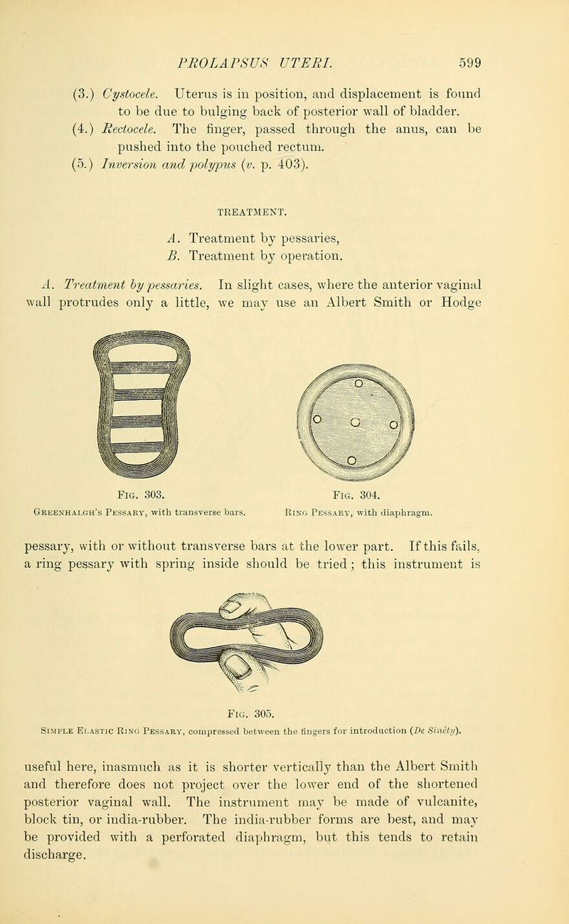 (3.) Cystocele. Uterus is in position, and displacement is found to be due to bulging back of posterior wall of bladder. (4.) Reciocele. The finger, passed through the anus, can be pushed into the pouched rectum. (5.) Inversion and polypus (v. p. 403). TREATMENT. A. Treatment by pessaries, B. Treatment by operation. A. Treatment by pessaries. In slight cases, where the anterior vaginal wall protrudes only a little, we may use an Albert Smith or Hodge Fig. 303. Greenhalgh's Pessary, with transverse bars. Fig. 304. Ring Pessary, with diaphragm. pessary, with or without transverse bars at the lower part. If this fails, a ring pessary with spring inside should be tried; this instrument is Fig. 305. Simple Elastic Ring Pessary, compressed between the fingers for introduction (De Sinety). useful hei'e, inasmuch as it is shorter vertically than the Albert Smith and therefore does not project over the lower end of the shortened posterior vaginal wall. The instrument may be made of vulcanite, block tin, or india-rubber. The india-rubber forms are best, and may be provided with a perforated diaphragm, but this tends to retain discharge.