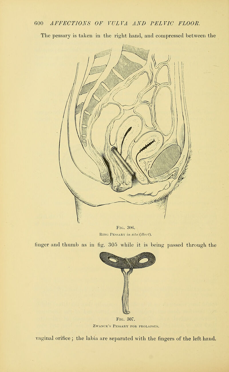 The pessary is taken in the right hand, and compressed between the Fig. 306. Ring Pessary in situ (Hart). finger and thumb as in fig. 305 while it is being passed through the Fig. 307. Zwanck's Pessary for prolapsus. vaginal orifice ; the labia are separated with the fingers of the left hand.