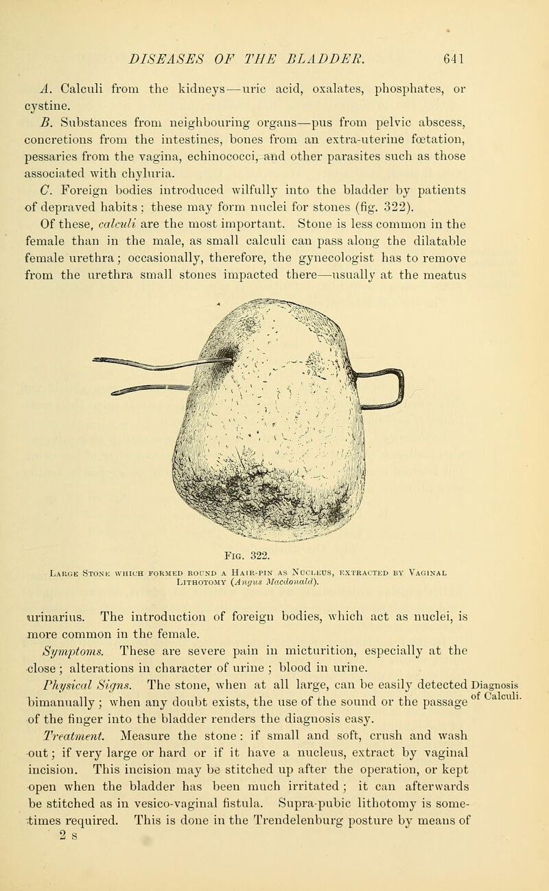 A. Calculi from the kidneys — uric acid, oxalates, phosphates, or cystine. B. Substances from neighbouring organs—pus from pelvic abscess, concretions from the intestines, bones from an exti'a-uterine fcetation, pessaries from the vagina, echinococci, and other parasites such as those associated with chyluria. C. Foreign bodies introduced wilfully into the bladder by patients of depraved habits; these may form nuclei for stones (fig. 322). Of these, calculi are the most important. Stone is less common in the female than in the male, as small calculi can pass along the dilatable female urethra; occasionally, therefore, the gynecologist has to remove from the urethra small stones impacted there—usually at the meatus Fig. 322. Large Stone which formed round a Hair-pin as Nucleus, extracted by Vaginal Lithotomy {Angus Macdonald). of Calculi. urinarius. The introduction of foreign bodies, which act as nuclei, is more common in the female. Symptoms. These are severe pain in micturition, especially at the •close ; alterations in character of urine ; blood in urine. Physical Signs. The stone, when at all large, can be easily detected Diagnosis bimanually ; when any doubt exists, the use of the sound or the passage of the finger into the bladder renders the diagnosis easy. Treatment. Measure the stone : if small and soft, crush and wash out; if very large or hard or if it have a nucleus, extract by vaginal incision. This incision may be stitched up after the operation, or kept open when the bladder has been much irritated ; it can afterwards be stitched as in vesico-vaginal fistula. Supra-pubic lithotomy is some- times required. This is done in the Trendelenburg posture by means of ' 2 s