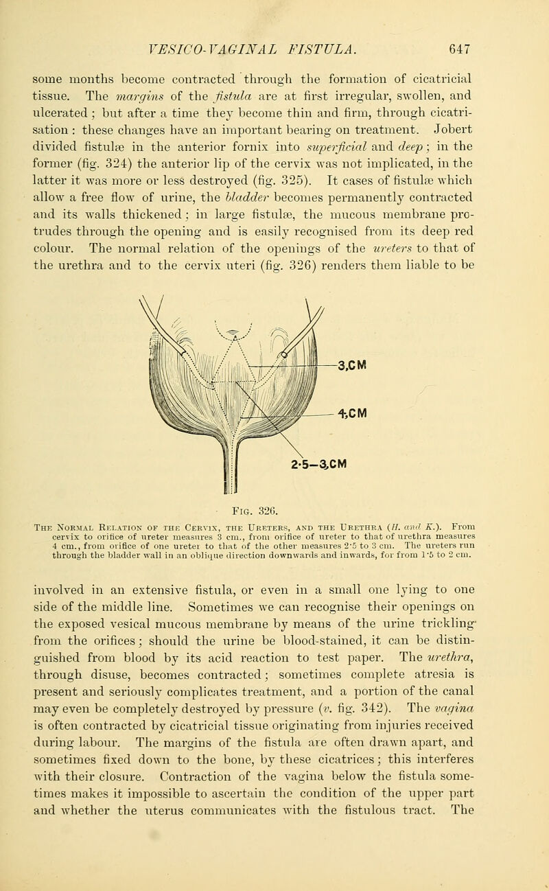 some months become contracted through the formation of cicatricial tissue. The margins of the fistula are at first irregular, swollen, and ulcerated; but after a time they become thin and firm, through cicatri- sation : these changes have an important bearing on treatment. Jobert divided fistulae in the anterior fornix into superficial and deep; in the former (fig. 324) the anterior lip of the cervix was not implicated, in the latter it was more or less destroyed (fig. 325). It cases of fistulse which allow a free flow of urine, the bladder becomes permanently contracted and its walls thickened ; in large fistulas, the mucous membrane pro- trudes through the opening and is easily recognised from its deep red colour. The normal relation of the openings of the ureters to that of the urethra and to the cervix uteri (fig. 326) renders them liable to be 2-5-3,CM ■ Fig. 326. The Normal Relation of the Cervix, the Ureters, and the Urethra (//. and K.). From cervix to orifice of ureter measures 3 cm., from orifice of ureter to that of urethra measures 4 cm., from orifice of one uretei to that of the other measures 2'5 to 3 cm. The ureters run through the bladder wall in an oblique direction downwards and inwards, for from l-5 to 2 cm. involved in an extensive fistula, or even in a small one lying to one side of the middle line. Sometimes we can recognise their openings on the exposed vesical mucous membrane by means of the urine trickling- from the orifices; should the urine be blood-stained, it can be distin- guished from blood by its acid reaction to test paper. The urethra, through disuse, becomes contracted; sometimes complete atresia is present and seriously complicates treatment, and a portion of the canal may even be completely destroyed by pressure (v. fig. 342). The vagina is often contracted by cicatricial tissue originating from injuries received during labour. The margins of the fistula are often drawn apart, and sometimes fixed down to the bone, by these cicatrices; this interferes with their closure. Contraction of the vagina below the fistula some- times makes it impossible to ascertain the condition of the upper part and whether the uterus communicates with the fistulous tract. The