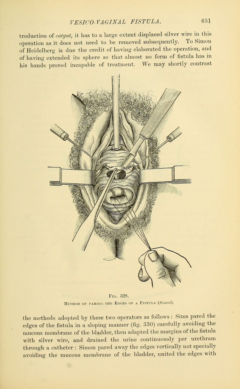 traduction of catgut, it has to a large extent displaced silver wire in this operation as it does not need to be removed subsequently. To Simon of Heidelberg is due the credit of having elaborated the operation, and of having extended its sphere so that almost no form of fistula has in his hands proved incapable of treatment. We may shortly contrast Fig. 328. Method of paring the Edges of a Fistula (Simon). the methods adopted by these two operators as follows : Sims pared the edges of the fistula in a sloping manner (fig. 330) carefully avoiding the mucous membrane of the bladder, then adapted the margins of the fistula with silver wire, and drained the urine continuously per urethram through a catheter : Simon pared away the edges vertically not specially avoiding the mucous membrane of the bladder, united the edges with