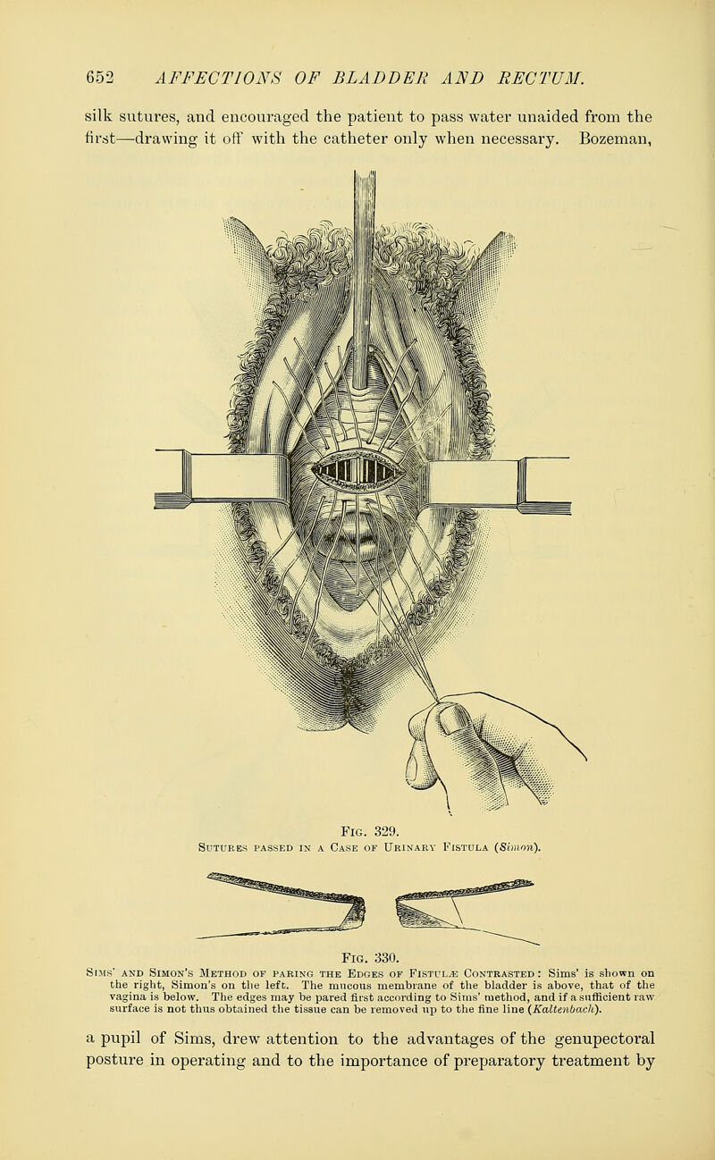 silk sutures, and encouraged the patient to pass water unaided from the first—drawing it off with the catheter only when necessary. Bozeman, Fig. 329. Sutures passed in a Case of Urinary Fistula (Simon). Fig. 330. Sims' and Simon's Method of paring the Edges of Fistul^e Contrasted: Sims' is shown on the right, Simon's on the left. The mncons membrane of the bladder is above, that of the vagina is below. The edges may be pared first according to Sims' method, and if a sufficient raw surface is not thus obtained the tissue can be removed up to the fine line (Kaltenbach). a pupil of Sims, drew attention to the advantages of the genupectoral posture in operating and to the importance of preparatory treatment by