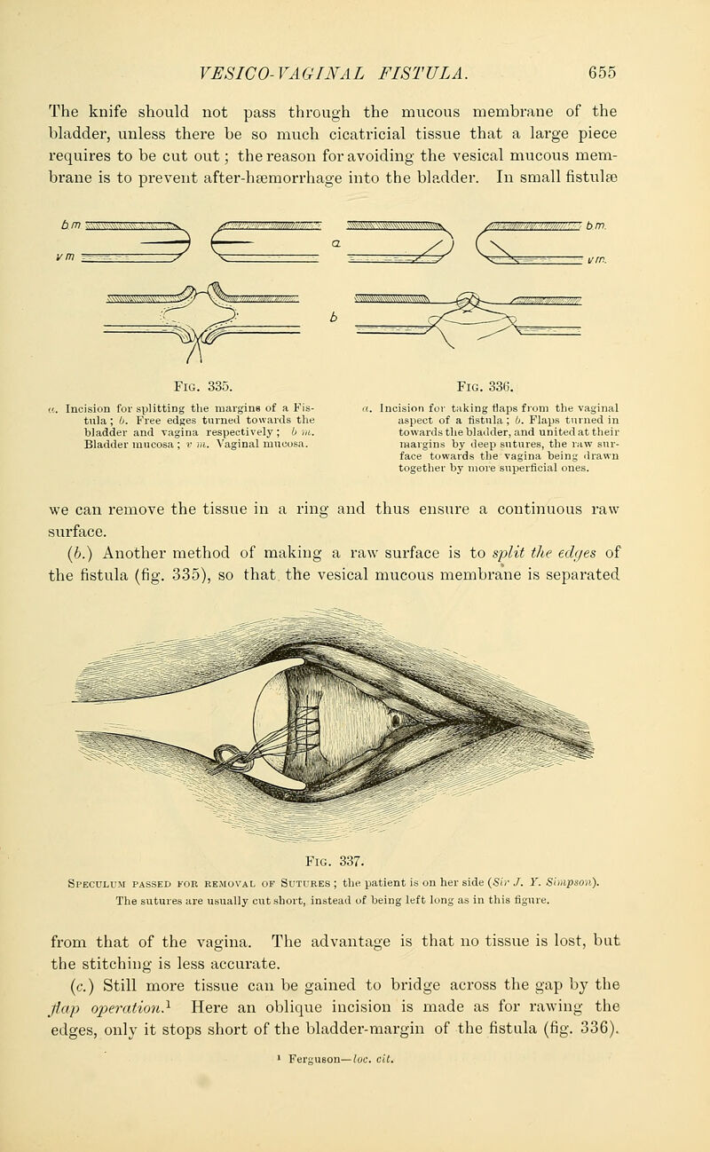 The knife should not pass through the mucous membrane of the bladder, unless there be so much cicatricial tissue that a lai-ge piece requires to be cut out; the reason for avoiding the vesical mucous mem- brane is to prevent after-haemorrhage into the bladder. In small fistula? 6/7? SSS&SM3ES3&.. vm ':,_ bm Fig. 335. Incision for splitting the margins of a Fis- tula ; b. Free edges turned towards the bladder and vagina respectively; b ra. Bladder mucosa ; v m. Vaginal mucosa. Fig. 336. Incision for taking flaps from the vaginal aspect of a fistula; b. Flaps turned in towards the bladder, and united at their margins by deep sutures, the raw sur- face towards the vagina being drawn together by move superficial ones. we can remove the tissue in a ring and thus ensure a continuous raw surface. (b.) Another method of making a raw surface is to split the edges of the fistula (fig. 335), so that the vesical mucous membrane is separated Fig. 337. Speculum passed for removal of Sutures ; the patient is on her side (Sir J. Y. Simpson). The sutures are usually cut short, instead of being left long as in this figure. from that of the vagina. The advantage is that no tissue is lost, but the stitching is less accurate. (c.) Still more tissue can be gained to bridge across the gap by the flap operation} Here an oblique incision is made as for rawing the edges, only it stops short of the bladder-margin of the fistula (fig. 336). 1 Ferguson—loc. cit.