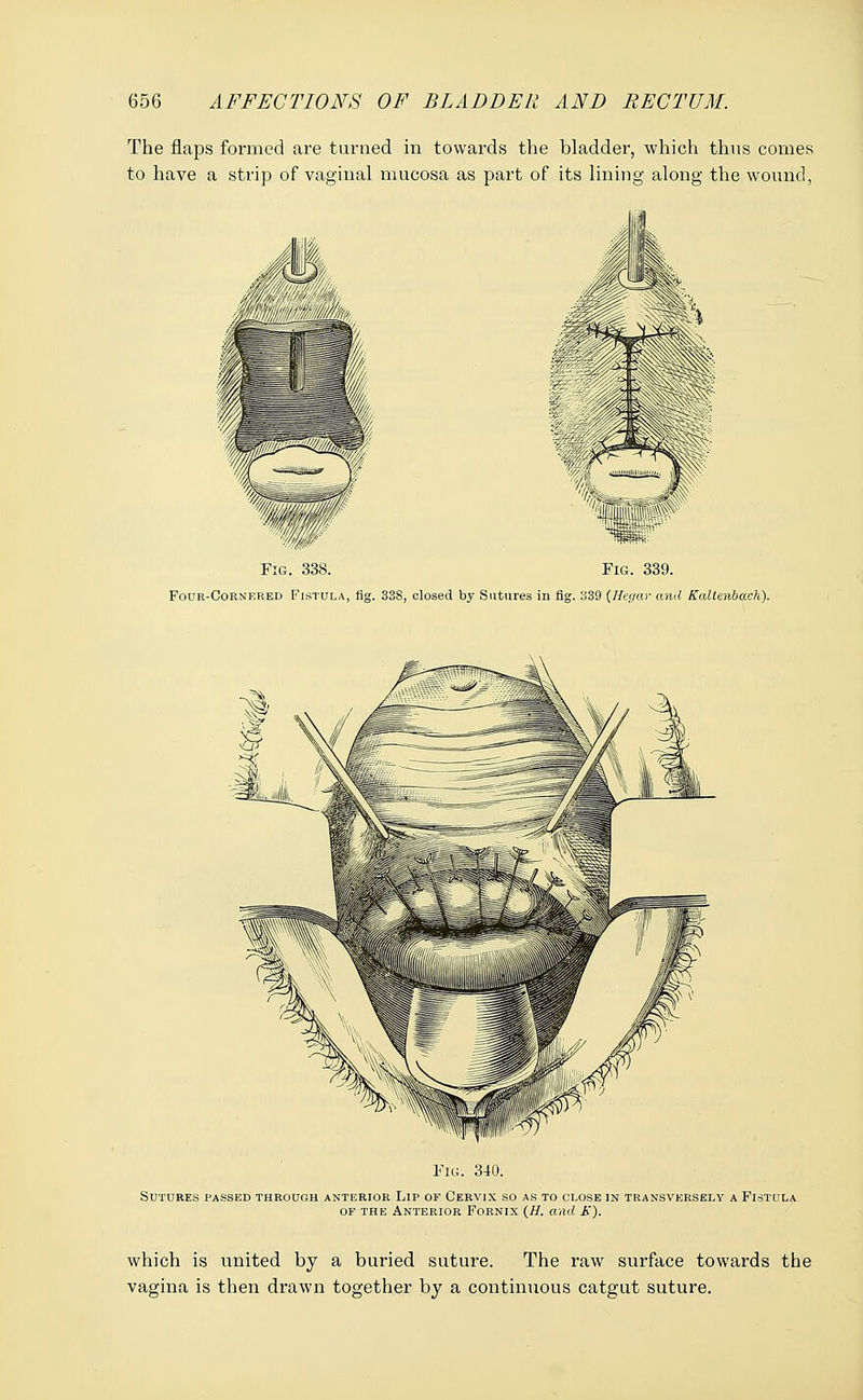 The flaps formed are turned in towards the bladder, which thus comes to have a strip of vaginal mucosa as part of its lining along the wound, Fig. 338. Fig. 339. Four-Cornered Fistula, fig. 33S, closed by Sutures in fig. 339 {Hegar and Kaltenbach). Fig. 340. Sutures passed through anterior Lip of Cervix so as to close in transversely a Fistula of the Anterior Fornix (H. and E). which is united by a buried suture. The raw surface towards the vagina is then drawn together by a continuous catgut suture.