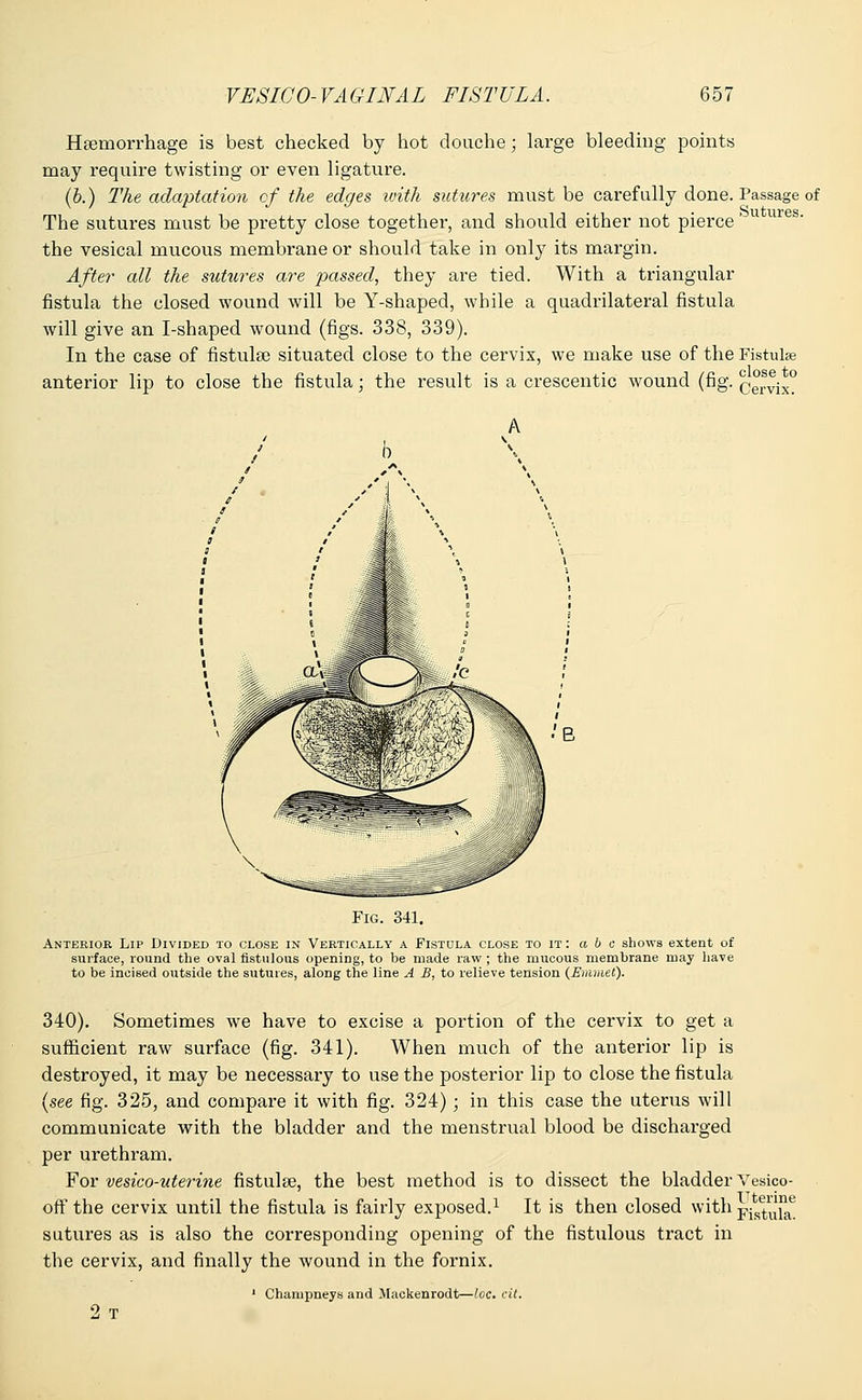 Haemorrhage is best checked by hot douche; large bleeding points may require twisting or even ligature. (b.) The adaptation of the edges with sutures must be carefully done. The sutures must be pretty close together, and should either not pierce the vesical mucous membrane or should take in only its margin. After all the sutures are passed, they are tied. With a triangular fistula the closed wound will be Y-shaped, while a quadrilateral fistula will give an I-shaped wound (figs. 338, 339). In the case of fistulse situated close to the cervix, we make use of the anterior lip to close the fistula; the result is a crescentic wound (fig. Passage of Sutures. Fistulse close to Cervix. Fig. 341. Anterior Lip Divided to close in Vertically a Fistula close to it : a b c shows extent of surface, round the oval fistulous opening, to be made raw ; the mucous membrane may have to be incised outside the sutures, along the line A B, to relieve tension (Emmet). 340). Sometimes we have to excise a portion of the cervix to get a sufficient raw surface (fig. 341). When much of the anterior lip is destroyed, it may be necessary to use the posterior lip to close the fistula (see fig. 325, and compare it with fig. 324); in this case the uterus will communicate with the bladder and the menstrual blood be discharged per urethram. For vesico-uterine fistulas, the best method is to dissect the bladder Vesico- off the cervix until the fistula is fairly exposed.1 It is then closed with pjf.^6 sutures as is also the corresponding opening of the fistulous tract in the cervix, and finally the wound in the fornix. 1 Champneys and Mackenrodt—loc. cit. 2 T