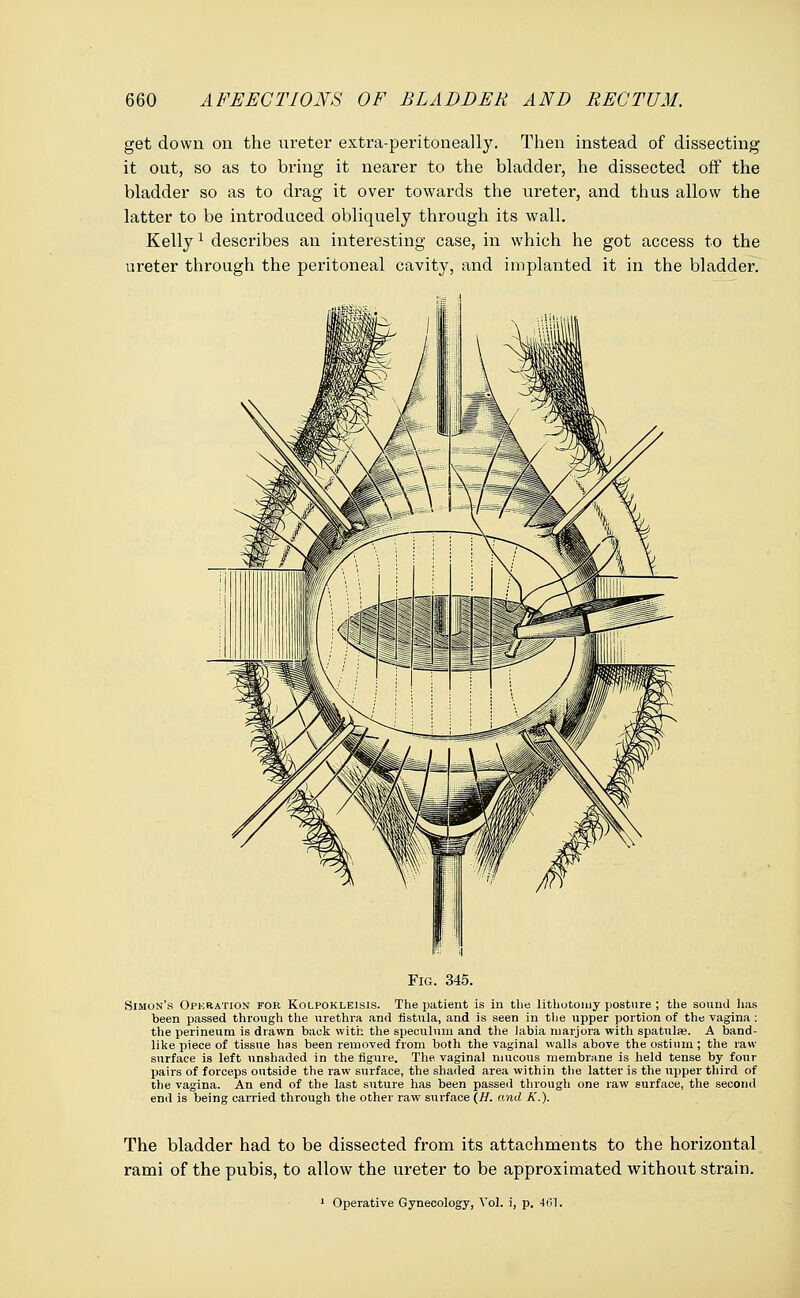 get down on the ureter extra-peritoneally. Then instead of dissecting it out, so as to bring it nearer to the bladder, he dissected off the bladder so as to drag it over towards the ureter, and thus allow the latter to be introduced obliquely through its wall. Kelly1 describes an interesting case, in which he got access to the ureter through the peritoneal cavity, and implanted it in the bladder. Fig. 345. Simon's Operation for Kolpokleisis. The patient is in the lithotomy posture ; the sound lias been passed through the urethra and fistula, and is seen in the upper portion of the vagina : the perineum is drawn back with the speculum and the labia niarjora with spatulse. A band- like piece of tissne has been removed from both the vaginal walls above the ostium; the raw snrface is left unshaded in the figure. The vaginal mucous membrane is held tense by four pairs of forceps outside the raw surface, the shaded area within the latter is the upper third of the vagina. An end of the last suture has been passed through one raw surface, the second end is being carried through the other raw surface (H. and A'.). The bladder had to be dissected from its attachments to the horizontal rami of the pubis, to allow the ureter to be approximated without strain. 1 Operative Gynecology, Vol. i, p. 461.