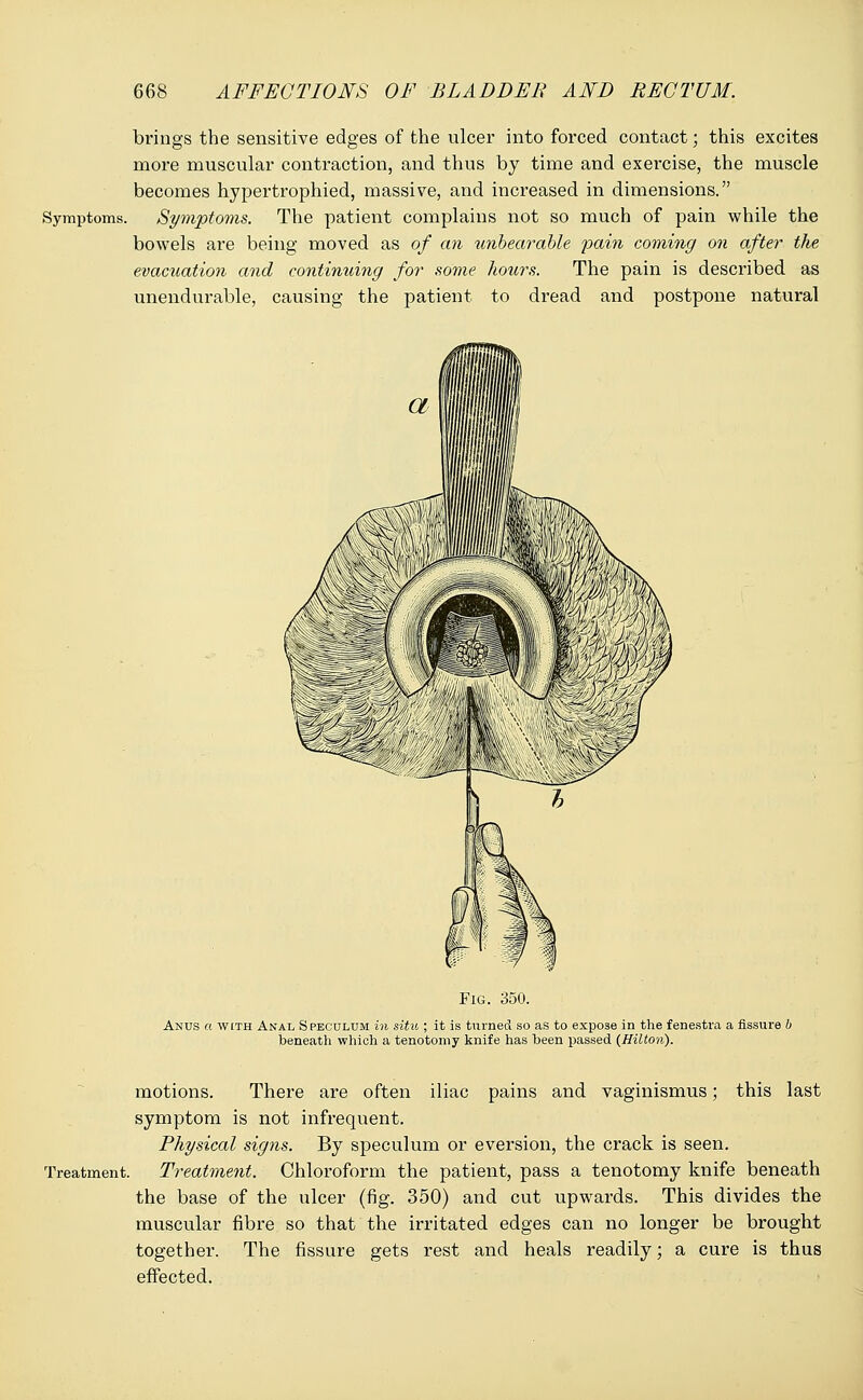 brings the sensitive edges of the ulcer into forced contact; this excites more muscular contraction, and thus by time and exercise, the muscle becomes hypertrophied, massive, and increased in dimensions. Symptoms. Symptoms. The patient complains not so much of pain while the bowels are being moved as of an unbearable pain coming on after the evacuation and continuing for some hours. The pain is described as unendurable, causing the patient to dread and postpone natural Fig. 350. Anus a with Anal Speculum in situ ; it is turned so as to expose in the fenestra a fissure b beneath which a tenotomy knife has been passed (Hilton). motions. There are often iliac pains and vaginismus; this last symptom is not infrequent. Physical signs. By speculum or eversion, the crack is seen. Treatment. Treatment. Chloroform the patient, pass a tenotomy knife beneath the base of the ulcer (fig. 350) and cut upwards. This divides the muscular fibre so that the irritated edges can no longer be brought together. The fissure gets rest and heals readily; a cure is thus effected.