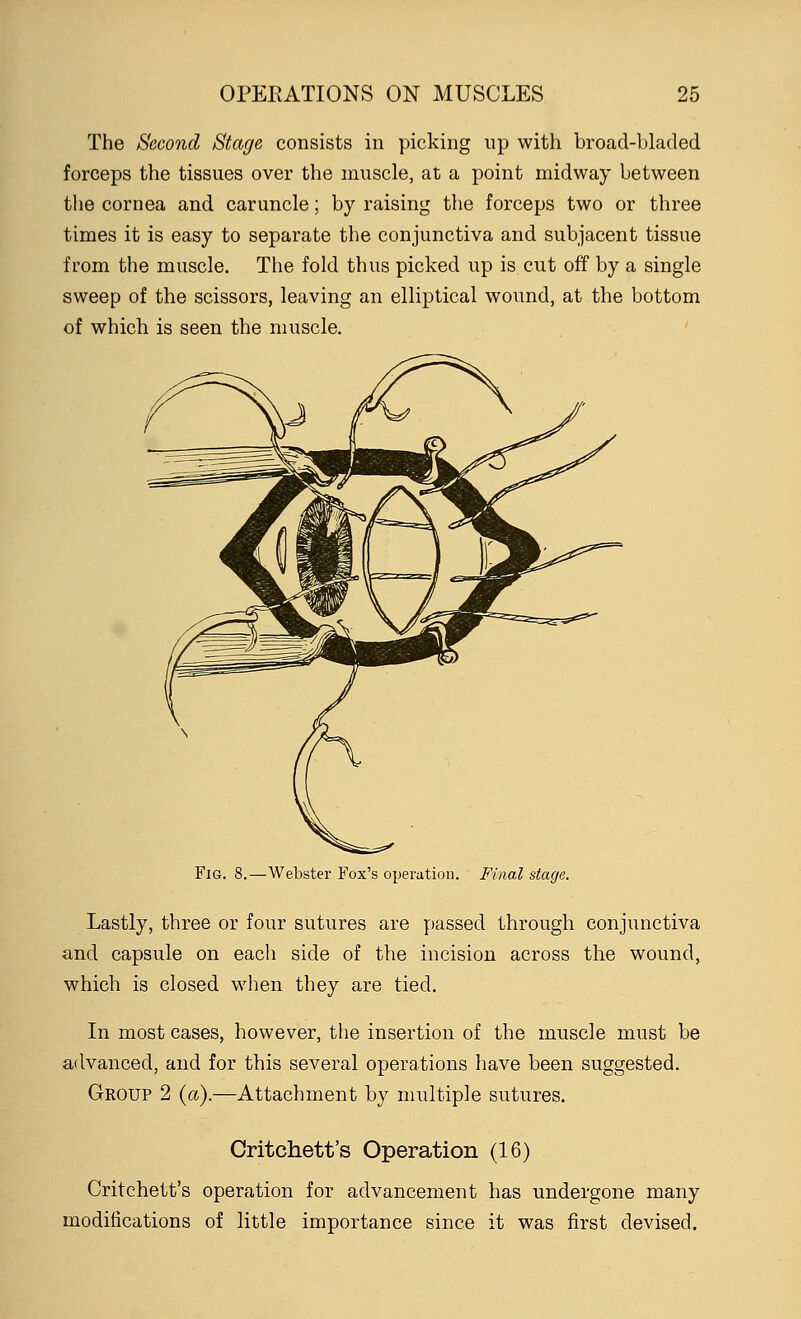 The Second Stage consists in picking up with broad-bladed forceps the tissues over the muscle, at a point midway between the cornea and caruncle; by raising the forceps two or three times it is easy to separate the conjunctiva and subjacent tissue from the muscle. The fold thus picked up is cut off by a single sweep of the scissors, leaving an elliptical wound, at the bottom of which is seen the muscle. Fig. 8.—Webster Fox's operation. Final stage. Lastly, three or four sutures are passed through conjunctiva and capsule on each side of the incision across the wound, which is closed when they are tied. In most cases, however, the insertion of the muscle must be advanced, and for this several operations have been suggested. Group 2 (a).—Attachment by multiple sutures. Critchett's Operation (16) Critchett's operation for advancement has undergone many modifications of little importance since it was first devised.