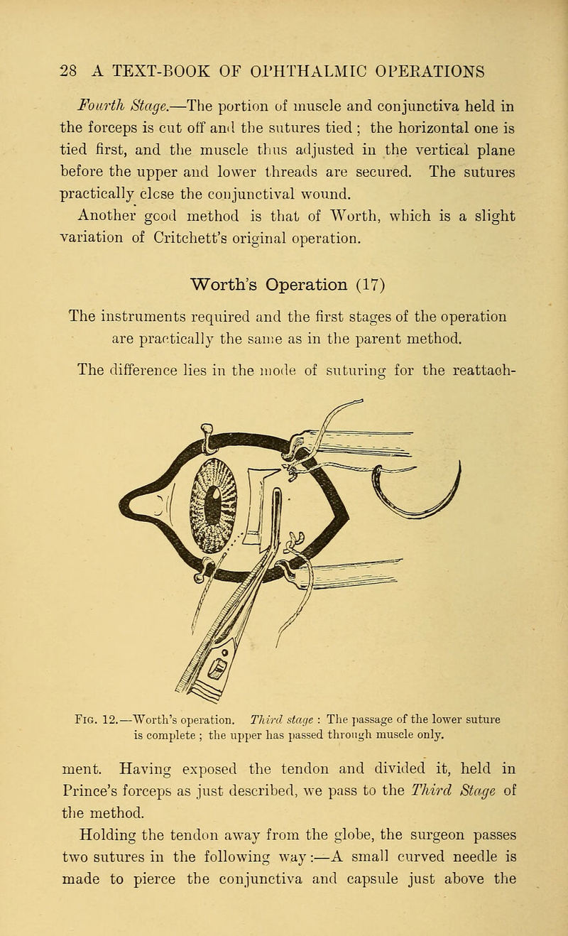 Fourth Stage.—The portion of muscle and conjunctiva held in the forceps is cut off and the sutures tied ; the horizontal one is tied first, and the muscle thus adjusted in the vertical plane before the upper and lower threads are secured. The sutures practically close the conjunctival wound. Another good method is that of Worth, which is a slight variation of Critchett's original operation. Worth's Operation (17) The instruments required and the first stages of the operation are practically the same as in the parent method. The difference lies in the mode of suturing for the reattaoh- FiG. 12.—Worth's operation. Third stage : The passage of the lower suture is complete ; the upper has passed through muscle only. ment. Having exposed the tendon and divided it, held in Prince's forceps as just described, we pass to the Third Stage of the method. Holding the tendon away from the globe, the surgeon passes two sutures in the following way:—A small curved needle is made to pierce the conjunctiva and capsule just above the