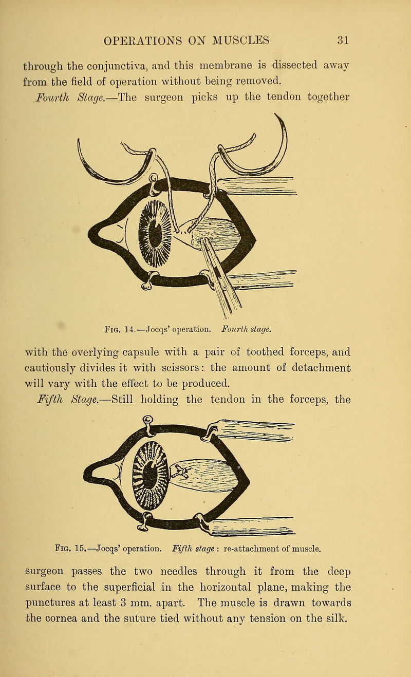 through the conjunctiva, and this membrane is dissected away from the field of operation without being removed. Fourth Stage.—The surgeon picks up the tendon together Fig. 14.—Jocqs'operation. Fourth stage. with the overlying capsule with a pair of toothed forceps, and cautiously divides it with scissors: the amount of detachment will vary with the effect to be produced. Fifth Stage.—Still holding the tendon in the forceps, the Fig. 15.—Jocqs'operation. Fifth stage : re-attachment of muscle. surgeon passes the two needles through it from the deep surface to the superficial in the horizontal plane, making the punctures at least 3 mm. apart. The muscle is drawn towards the cornea and the suture tied without any tension on the silk.