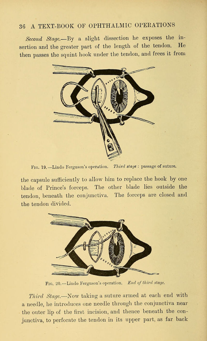 Second Stage.—By a slight dissection he exposes the in- sertion and the greater part of the length of the tendon. He then passes the squint hook under the tendon, and frees it from Fig. 19.—Lindo Ferguson's operation. Third stage : passage of suture. the capsule sufficiently to allow him to replace the hook by one blade of Prince's forceps. The other blade lies outside the tendon, beneath the conjunctiva. The forceps are closed and the tendon divided. Fig. 20.—Lindo Ferguson's operation. End of third stage. Third Stage.—Now taking a suture armed at each end with a needle, he introduces one needle through the conjunctiva near the outer lip of the first incision, and thence beneath the con- junctiva, to perforate the tendon in its upper part, as far back