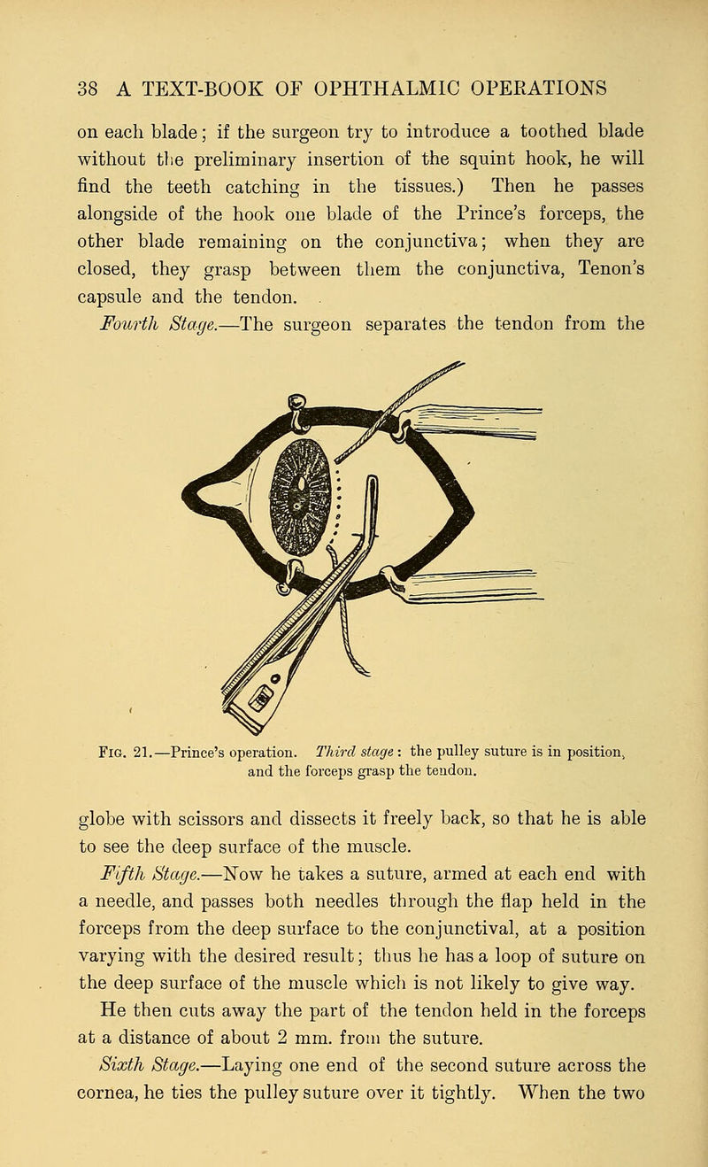 on each blade; if the surgeon try to introduce a toothed blade without the preliminary insertion of the squint hook, he will find the teeth catching in the tissues.) Then he passes alongside of the hook one blade of the Prince's forceps, the other blade remaining on the conjunctiva; when they are closed, they grasp between them the conjunctiva, Tenon's capsule and the tendon. . Fourth Stage.—The surgeon separates the tendon from the Fig. 21.—Prince's operation. Third stage : the pulley suture is in position> and the forceps grasp the tendon. globe with scissors and dissects it freely back, so that he is able to see the deep surface of the muscle. Fifth Stage.—Now he takes a suture, armed at each end with a needle, and passes both needles through the flap held in the forceps from the deep surface to the conjunctival, at a position varying with the desired result; thus he has a loop of suture on the deep surface of the muscle which is not likely to give way. He then cuts away the part of the tendon held in the forceps at a distance of about 2 mm. from the suture. Sixth Stage.—Laying one end of the second suture across the cornea, he ties the pulley suture over it tightly. When the two