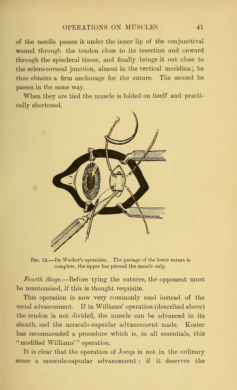 of the needle passes it under the inner lip of the conjunctival wound through the tendon close to its insertion and onward through the episcleral tissue, and finally brings it out close to the sclero-corneal junction, almost in the vertical meridian ; he thus obtains a firm anchorage for the suture. The second he passes in the same way. When they are tied the muscle is folded on itself and practi- cally shortened. Fig. 24.—De Wecker's operation. The passage of the lower suture is complete, the upper has pierced the muscle only. Fourth Stage.—Before tying the sutures, the opponent must be tenotomised, if this is thought requisite. This operation is now very commonly used instead of the usual advancement. If in Williams' operation (described above) the tendon is not divided, the muscle can be advanced in its sheath, and the musculo-capsular advancement made. Koster has recommended a procedure which is, in all essentials, this  modified Williams'  operation. It is clear that the operation of Jocqs is not in the ordinary sense a musculo-capsular advancement : if it deserves the