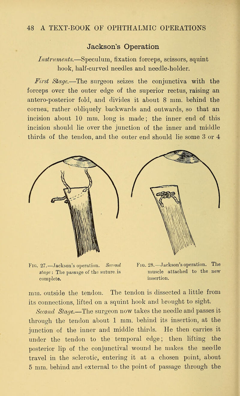 Jackson's Operation Instruments.—Speculum, fixation forceps, scissors, squint hook, half-curved needles and needle-holder. First Stage.—The surgeon seizes the conjunctiva with the forceps over the outer edge of the superior rectus, raising an antero-posterior fold, and divides it about 8 mm. behind the cornea, rather obliquely backwards and outwards, so that an incision about 10 mm. long is made; the inner end of this incision should lie over the junction of the inner and middle thirds of the tendon, and the outer end should lie some 3 or 4 Fig. 27.—Jackson's operation. Second stage : The passage of the suture is complete. Fig. 28.—Jackson's operation. The muscle attached to the new insertion. mm. outside the tendon. The tendon is dissected a little from its connections, lifted on a squint hook and brought to sight. Second Stage.—The surgeon now takes the needle and passes it through the tendon about 1 mm. behind its insertion, at the junction of the inner and middle thirds. He then carries it under the tendon to the temporal edge; then lifting the posterior lip of the conjunctival wound he makes the needle travel in the sclerotic, entering it at a chosen point, about 5 mm. behind and external to the point of passage through the