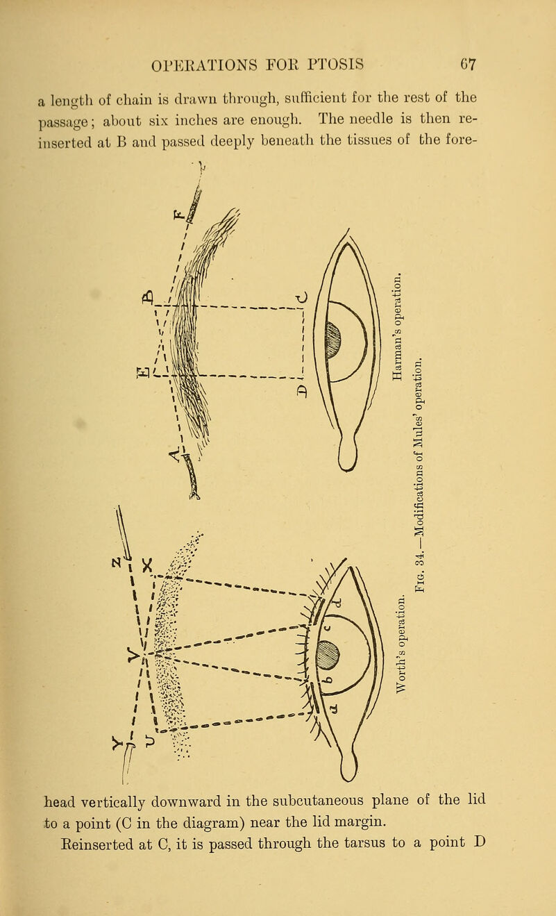 a length of chain is drawn through, sufficient for the rest of the passage; about six inches are enough. The needle is then re- inserted at B and passed deeply beneath the tissues of the fore- . ty &£; 'I && head vertically downward in the subcutaneous plane of the lid to a point (C in the diagram) near the lid margin. Reinserted at C, it is passed through the tarsus to a point D