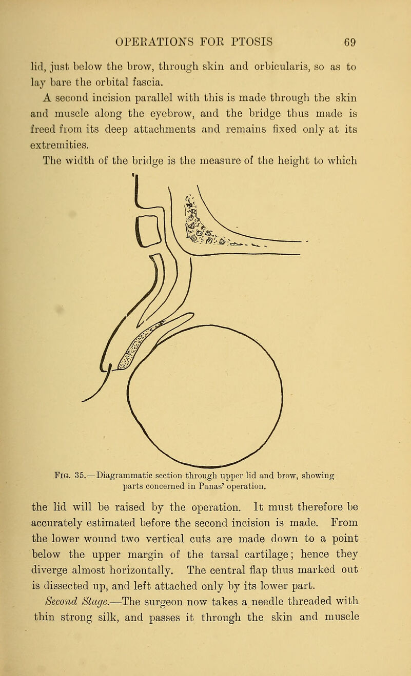 lid, just below the brow, through skin and orbicularis, so as to lay bare the orbital fascia. A second incision parallel with this is made through the skin and muscle along the eyebrow, and the bridge thus made is freed from its deep attachments and remains fixed only at its extremities. The width of the bridge is the measure of the height to which Fig. 35. — Diagrammatic section through upper lid and brow, showing parts concerned in Panas' operation. the lid will be raised by the operation. It must therefore be accurately estimated before the second incision is made. From the lower wound two vertical cuts are made down to a point below the upper margin of the tarsal cartilage; hence they diverge almost horizontally. The central flap thus marked out is dissected up, and left attached only by its lower part. Second Stage.—The surgeon now takes a needle threaded with thin strong silk, and passes it through the skin and muscle