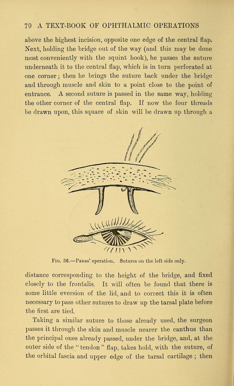 above the highest incision, opposite one edge of the central flap. Next, holding the bridge out of the way (and this may be done roost conveniently with the squint hook), he passes the suture underneath it to the central flap, which is in turn perforated at one corner; then he brings the suture back under the bridge and through muscle and skin to a point close to the point of entrance. A second suture is passed in the same way, holding the other corner of the central flap. If now the four threads be drawn upon, this square of skin will be drawn up through a ui-UJl^4£ Fig. 36.—Panas' operation. Sutures on the left side only. distance corresponding to the height of the bridge, and fixed closely to the frontalis. It will often be found that there is some little eversion of the lid, and to correct this it is often necessary to pass other sutures to draw up the tarsal plate before the first are tied. Taking a similar suture to those already used, the surgeon passes it through the skin and muscle nearer the canthus than the principal ones already passed, under the bridge, and, at the outer side of the  tendon  flap, takes hold, with the suture, of the orbital fascia and upper edge of the tarsal cartilage ; then