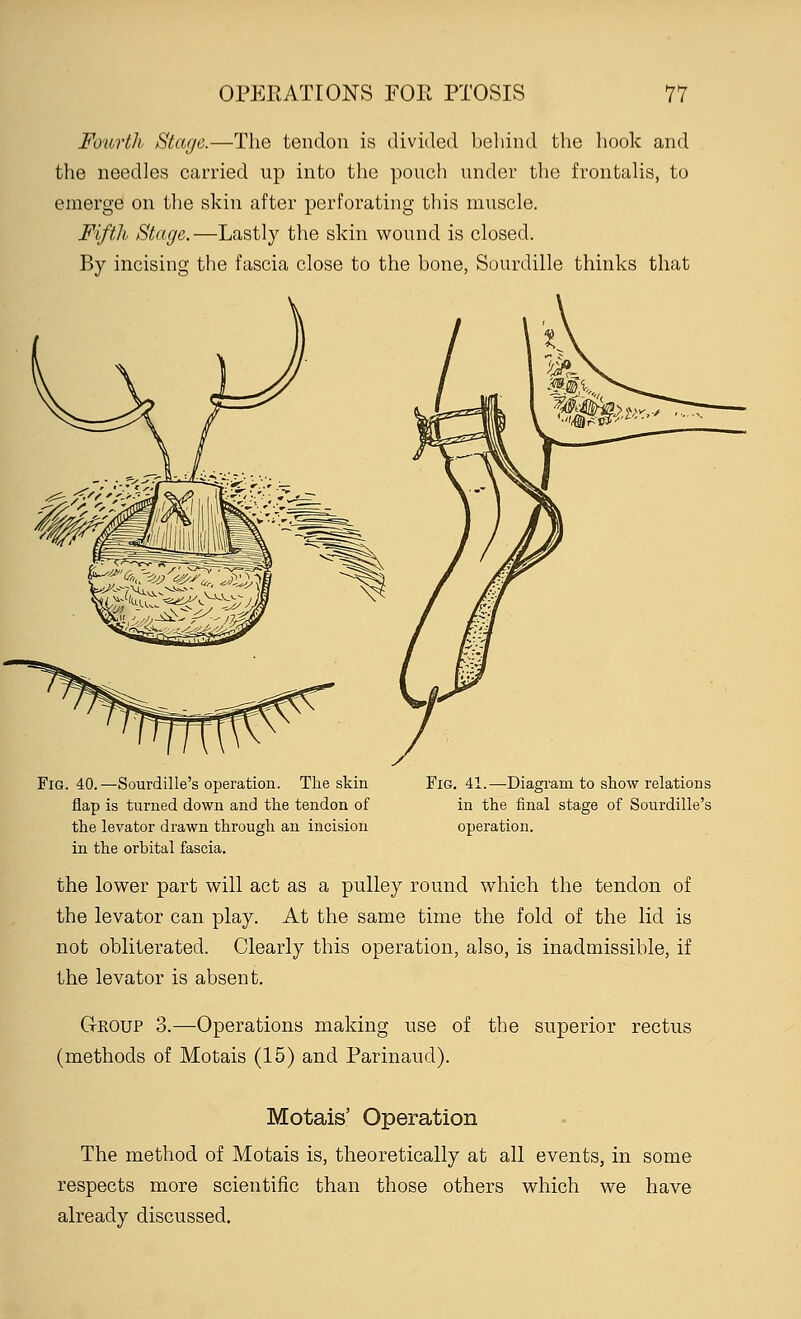 Fourth Stage.—The tendon is divided behind the hook and the needles carried up into the pouch under the frontalis, to emerge on the skin after perforating this muscle. Fifth Stage.—Lastly the skin wound is closed. By incising the fascia close to the bone, Sourdille thinks that Fig. 40.—Sourdille's operation. The skin flap is turned down and the tendon of the levator drawn through an incision in the orbital fascia. Fig. 41.—Diagram to show relations in the final stage of Sourdille's operation. the lower part will act as a pulley round which the tendon of the levator can play. At the same time the fold of the lid is not obliterated. Clearly this operation, also, is inadmissible, if the levator is absent. G-roup 3.—-Operations making use of the superior rectus (methods of Motais (15) and Parinaud). Motais' Operation The method of Motais is, theoretically at all events, in some respects more scientific than those others which we have already discussed.