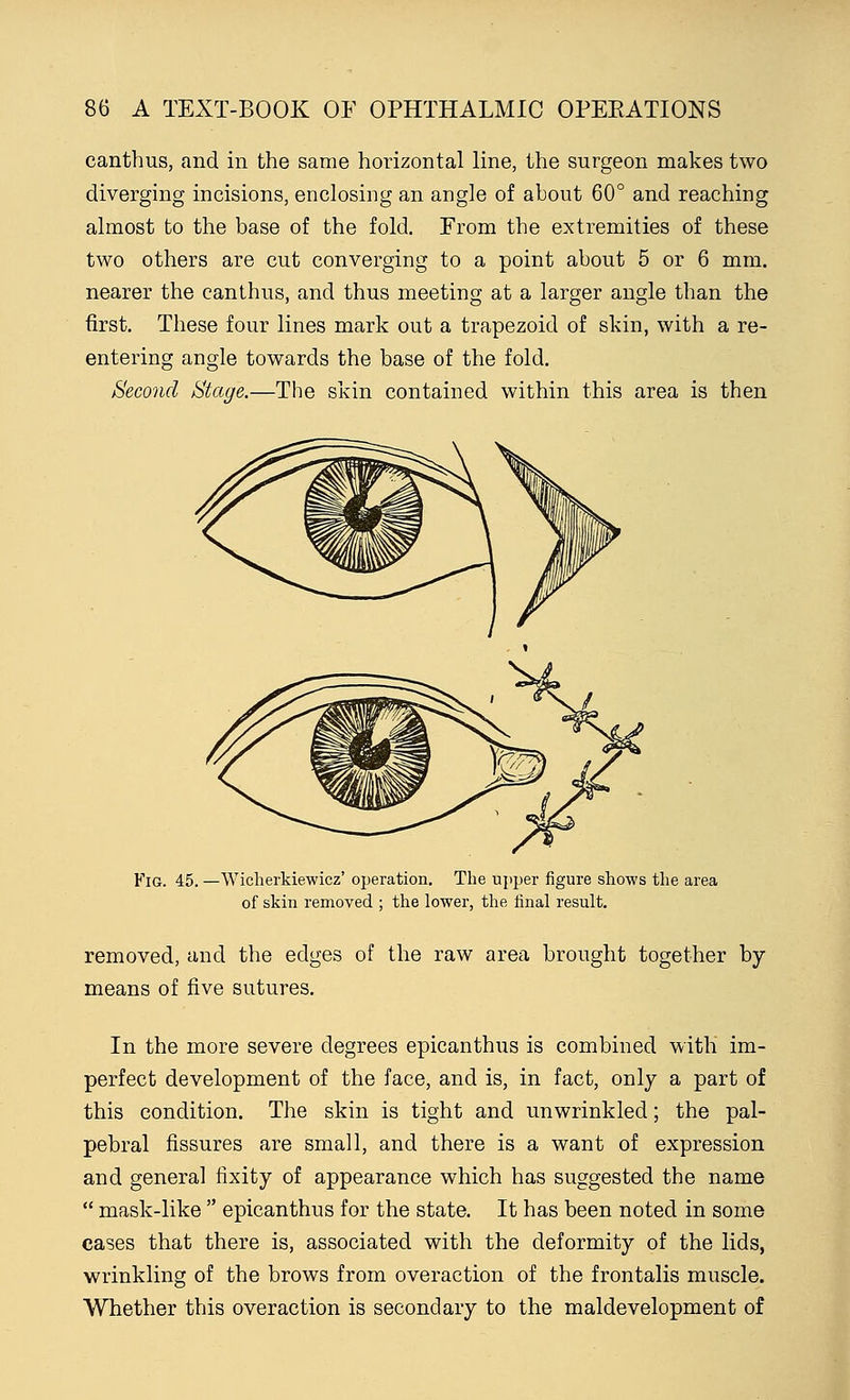 canthus, and in the same horizontal line, the surgeon makes two diverging incisions, enclosing an angle of about 60° and reaching almost to the base of the fold. From the extremities of these two others are cut converging to a point about 5 or 6 mm. nearer the canthus, and thus meeting at a larger angle than the first. These four lines mark out a trapezoid of skin, with a re- entering angle towards the base of the fold. Second Stage.—The skin contained within this area is then Fig. 45. —Wicherkiewicz' operation. The upper figure shows the area of skin removed ; the lower, the final result. removed, and the edges of the raw area brought together by means of five sutures. In the more severe degrees epicanthus is combined with im- perfect development of the face, and is, in fact, only a part of this condition. The skin is tight and unwrinkled; the pal- pebral fissures are small, and there is a want of expression and general fixity of appearance which has suggested the name  mask-like  epicanthus for the state. It has been noted in some cases that there is, associated with the deformity of the lids, wrinkling of the brows from overaction of the frontalis muscle. Whether this overaction is secondary to the maldevelopment of