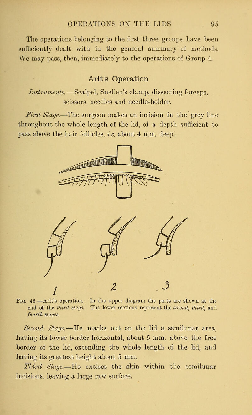 The operations belonging to the first three groups have been sufficiently dealt with in the general summary of methods. We may pass, then, immediately to the operations of Group 4. Arlt's Operation Instruments. —Scalpel, Snellen's clamp, dissecting forceps, scissors, needles and needle-holder. First Stage.—The surgeon makes an incision in the grey line throughout the whole length of the lid, of a depth sufficient to pass above the hair follicles, i.e. about 4 mm. deep. / 3 Fig. 46.—Arlt's operation. In the upper diagram the parts are shown at the end of the third stage. The lower sections represent the second, third, and fourth stages. Second Stage.—He marks out on the lid a semilunar area, having its lower border horizontal, about 5 mm. above the free horder of the lid, extending the whole length of the lid, and having its greatest height about 5 mm. Third Stage.—He excises the skin within the semilunar incisions, leaving a large raw surface.