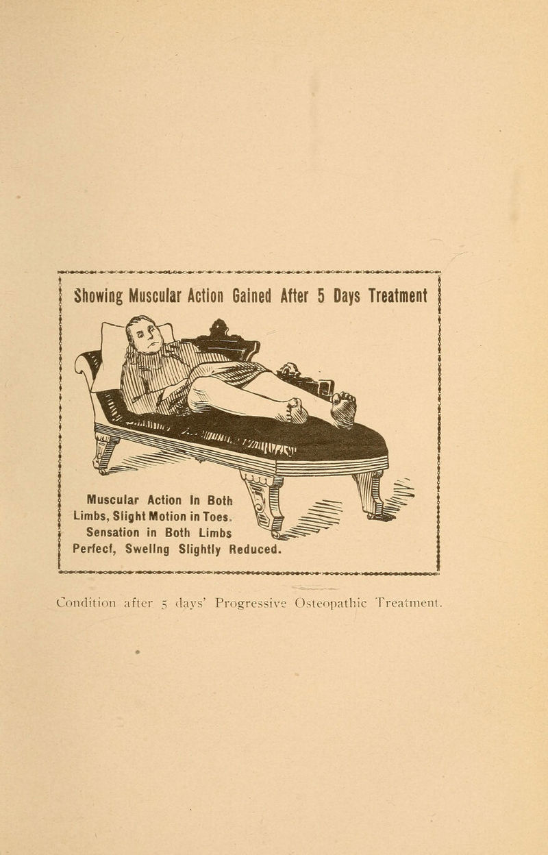 Showing Muscular Action Gained After 5 Days Treatment Muscular Action In Both Limbs, Slight Motion in Toes, Sensation in Both Limbs Perfect, Swellng Slightly Reduced. Condition after 5 days' Progressive Osteopathic Treatment.