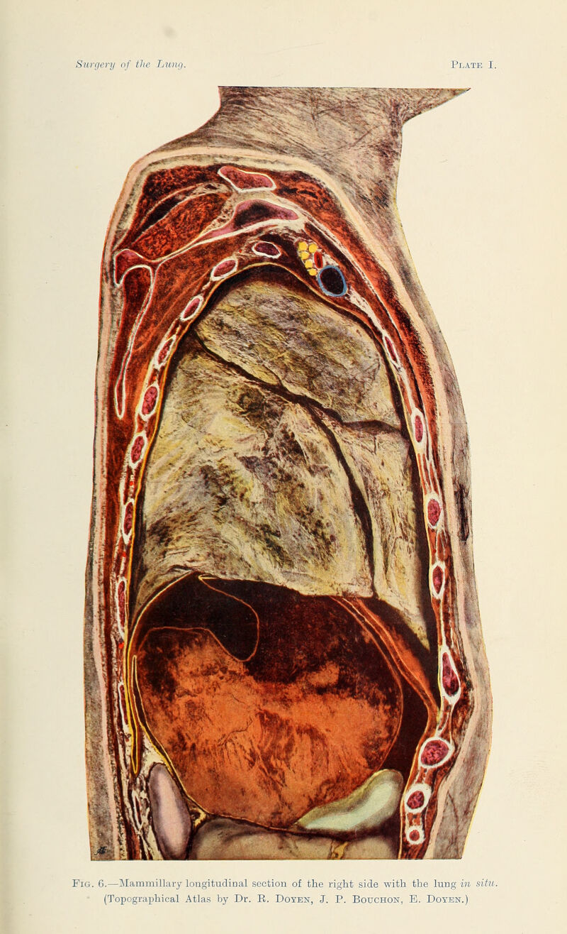 Fig. 6.—Mammillary longitudinal section of the right side with the lung in situ. (Topographical Atlas by Dr. R. Doyen, J. P. Bouchon, E. Doyen.)