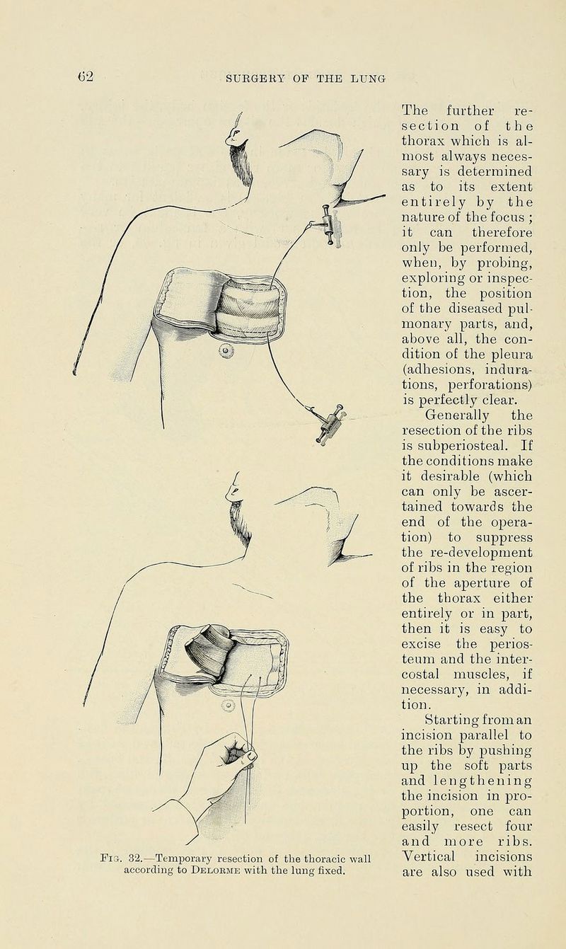 Fig. 32.—Temporary resection of the thoracic wall according to Delorme with the lung fixed. The further re- section of the thorax which is al- most always neces- sary is determined as to its extent entirely by the nature of the focus ; it can therefore only be performed, when, by probing, exploring or inspec- tion, the position of the diseased pul- monary parts, and, above all, the con- dition of the pleura (adhesions, indura- tions, perforations) is perfectly clear. Generally the resection of the ribs is subperiosteal. If the conditions make it desirable (which can only be ascer- tained towards the end of the opera- tion) to suppress the re-development of ribs in the region of the aperture of the thorax either entirely or in part, then it is easy to excise the perios- teum and the inter- costal muscles, if necessary, in addi- tion. Starting from an incision parallel to the ribs by pushing up the soft parts and lengthening the incision in pro- portion, one can easily resect four and more ribs. Vertical incisions are also used with