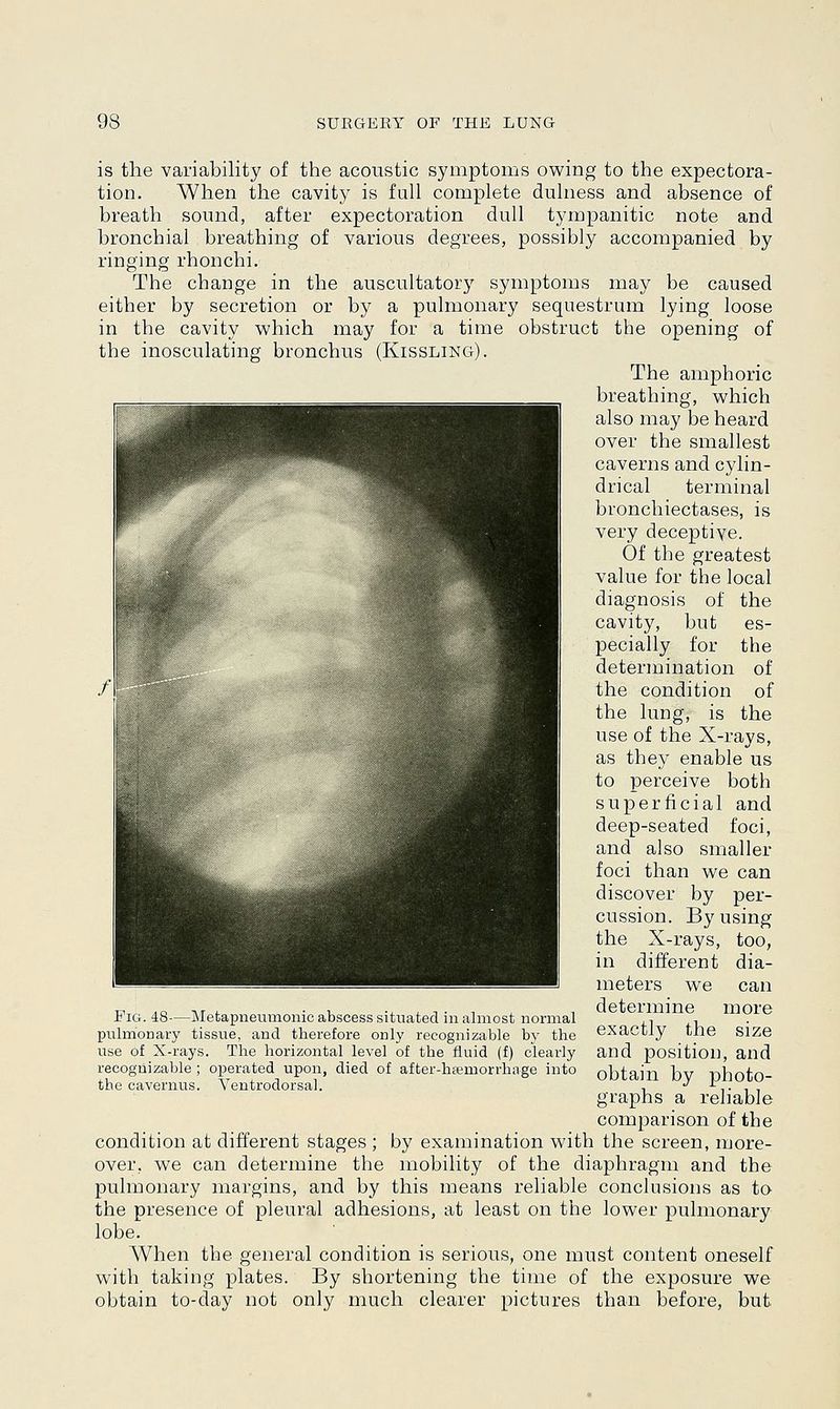 is the variability of the acoustic symptoms owing to the expectora- tion. When the cavity is fall complete dulness and absence of breath sound, after expectoration dull tympanitic note and bronchial breathing of various degrees, possibly accompanied by ringing rhonchi. The change in the auscultatory symptoms may be caused either by secretion or by a pulmonary sequestrum lying loose in the cavity which may for a time obstruct the opening of the inosculating bronchus (Kissling). The amphoric breathing, which also may be heard over the smallest caverns and cylin- drical terminal bronchiectases, is very deceptive. Of the greatest value for the local diagnosis of the cavity, but es- pecially for the determination of the condition of the lung, is the use of the X-rays, as they enable us to perceive both superficial and deep-seated foci, and also smaller foci than we can discover by per- cussion. By using the X-rays, too, in different dia- meters we can determine more exactly the size and position, and obtain by photo- graphs a reliable comparison of the condition at different stages ; by examination with the screen, more- over, we can determine the mobility of the diaphragm and the pulmonary margins, and by this means reliable conclusions as to the presence of pleural adhesions, at least on the lower pulmonary lobe. When the general condition is serious, one must content oneself with taking plates. By shortening the time of the exposure we obtain to-day not only much clearer pictures than before, but Fig. 48—Metapneumonic abscess situated in almost normal pulmonary tissue, and therefore only recognizable by the use of X-rays. The horizontal level of the fluid (f) clearly recognizable ; operated upon, died of after-haemorrhage into the cavernus. Ventrodorsal.