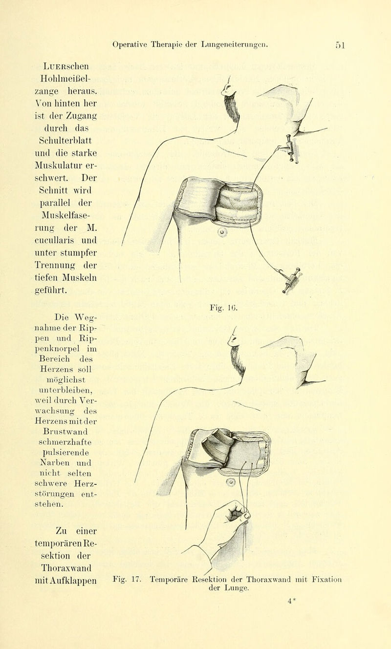 LuERschen Hohlmeißel- zange heraus. Von hinten her ist der Zugang durch das Schulterblatt und die starke Muskulatur er- schwert. Der Schnitt wird parallel der Muskelfase- rung der M. cucullaris und unter stumpfer Trennung der tiefen Muskeln geführt. Die Weg- nahme der Rip- pen und Rip- penknorpel im Bereich des Herzens soll möglichst unterbleiben, weil durch Ver- wachsung des Herzens mit der Brustwand schmerzhafte pulsierende Narben und nicht selten schwere Herz- störungen ent- stehen. Zu einer temporären Re- sektion der Thoraxwand mit Aufklappen Fig. IG. Fig. 17. Temporäre Resektion der Thoraxwand mit Fixation der Lunge.