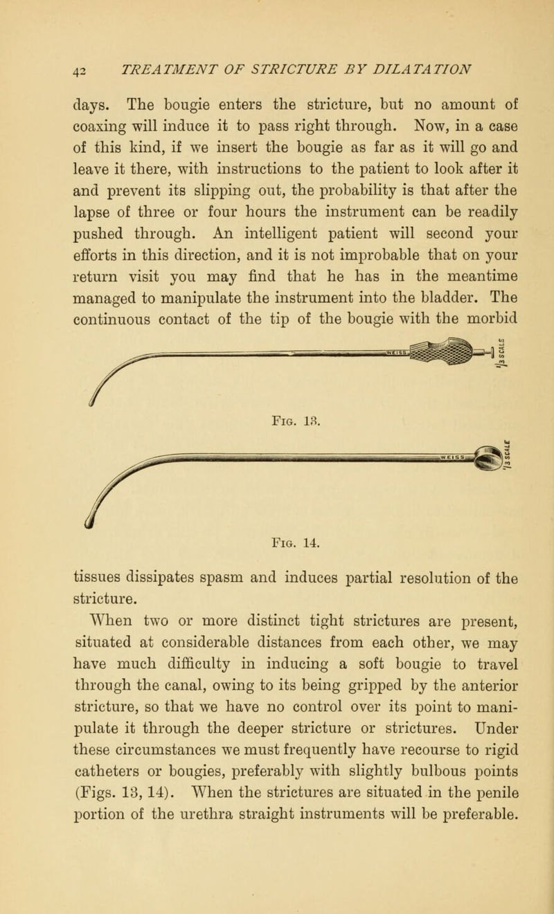 days. The bougie enters the stricture, but no amount of coaxing will induce it to pass right through. Now, in a case of this kind, if we insert the bougie as far as it will go and leave it there, with instructions to the patient to look after it and prevent its slipping out, the probability is that after the lapse of three or four hours the instrument can be readily pushed through. An intelligent patient will second your efforts in this direction, and it is not improbable that on your return visit you may find that he has in the meantime managed to manipulate the instrument into the bladder. The continuous contact of the tip of the bougie with the morbid Fig. 13. Fig. 14. tissues dissipates spasm and induces partial resolution of the stricture. When two or more distinct tight strictures are present, situated at considerable distances from each other, we may have much difficulty in inducing a soft bougie to travel through the canal, owing to its being gripped by the anterior stricture, so that we have no control over its point to mani- pulate it through the deeper stricture or strictures. Under these circumstances we must frequently have recourse to rigid catheters or bougies, preferably with slightly bulbous points (Figs. 13, 14). When the strictures are situated in the penile portion of the urethra straight instruments will be preferable.