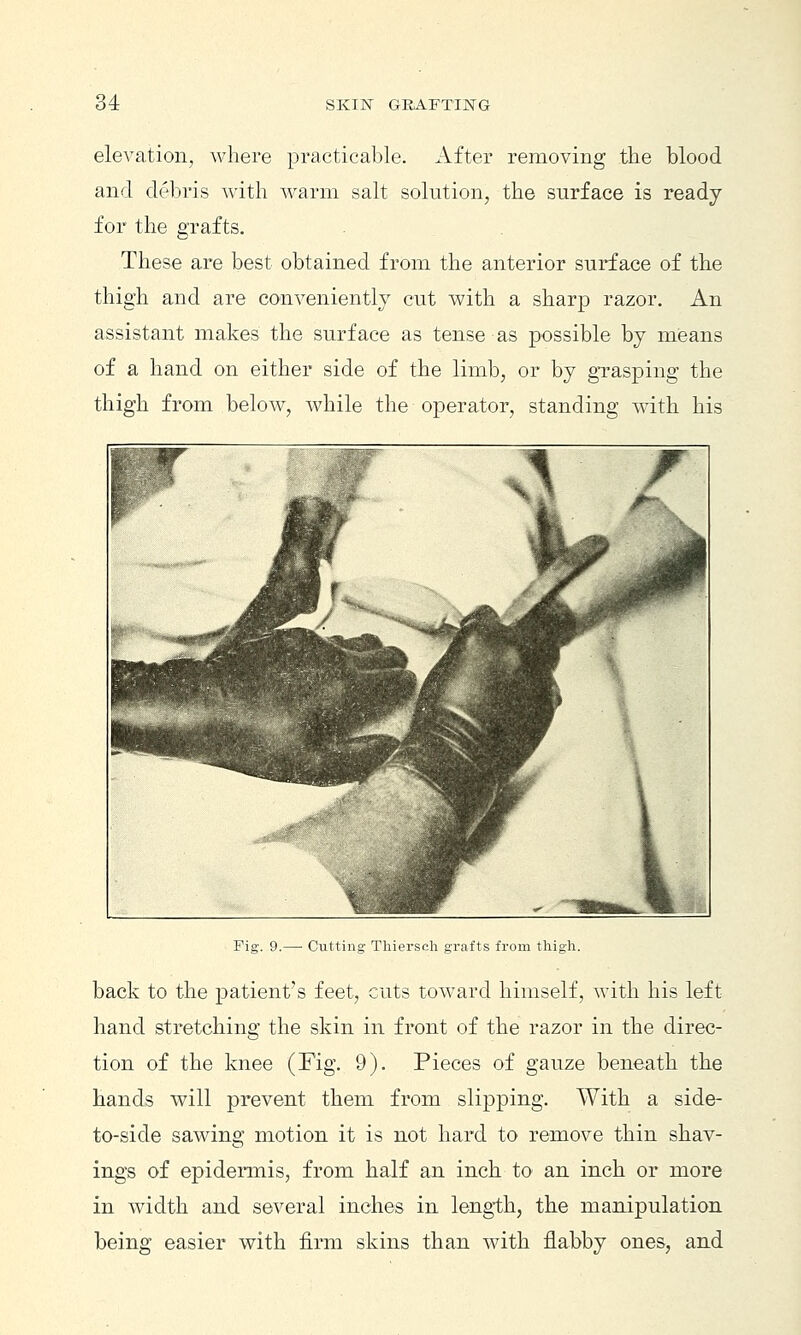 elevation, where practicable. After removing the blood and debris with warm salt solution, the surface is ready for the grafts. These are best obtained from the anterior surface of the thigh and are conveniently cut with a sharp razor. An assistant makes the surface as tense as possible by mieans of a hand on either side of the limb, or by grasping the thigh from below, while the operator, standing with his Fig. 9.— Cutting Thiersch grafts from thigh. back to the patient's feet, cuts toward himself, with his left hand stretching the skin in front of the razor in the direc- tion of the knee (Fig. 9). Pieces of gauze beneath the hands will prevent them from slipping. With a side- to-side sawing motion it is not hard to remove thin shav- ings of epidermis, from half an inch to an inch or more in width and several inches in leng-th, the manipulation being easier with firm skins than with flabby ones, and